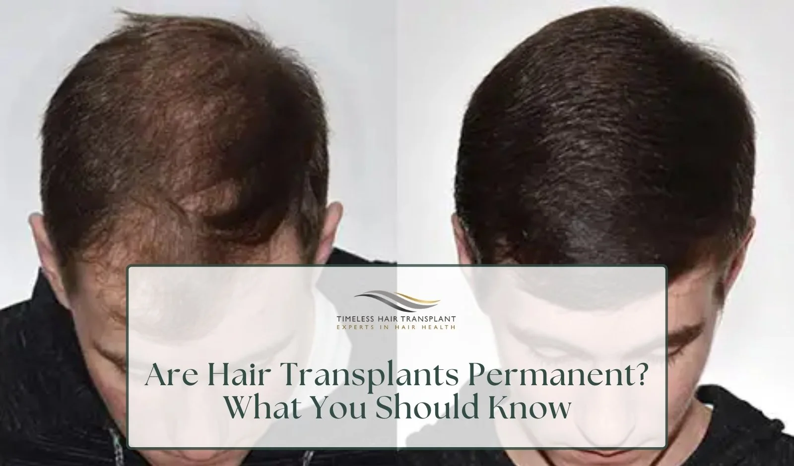 Are Hair Transplants Permanent? What You Should Know