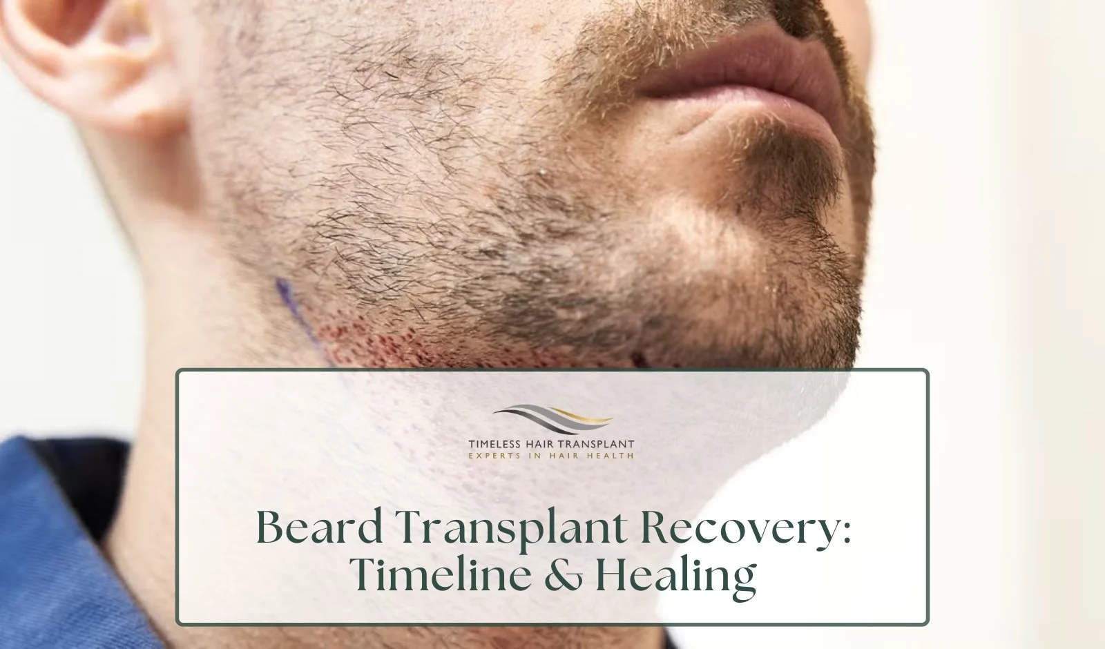 Beard Transplant Recovery: Timeline &amp; Healing