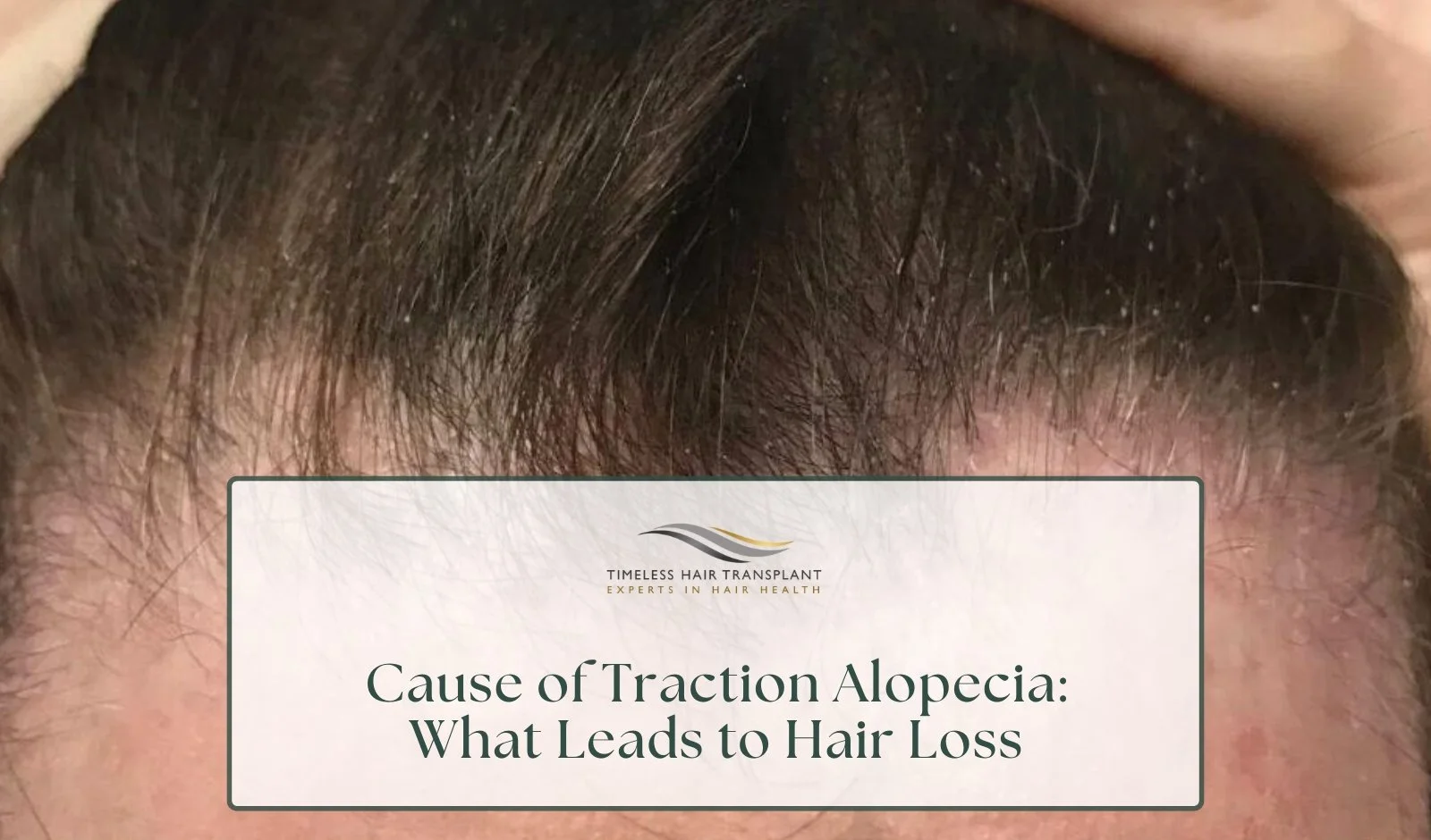 Cause of Traction Alopecia: What Leads to Hair Loss