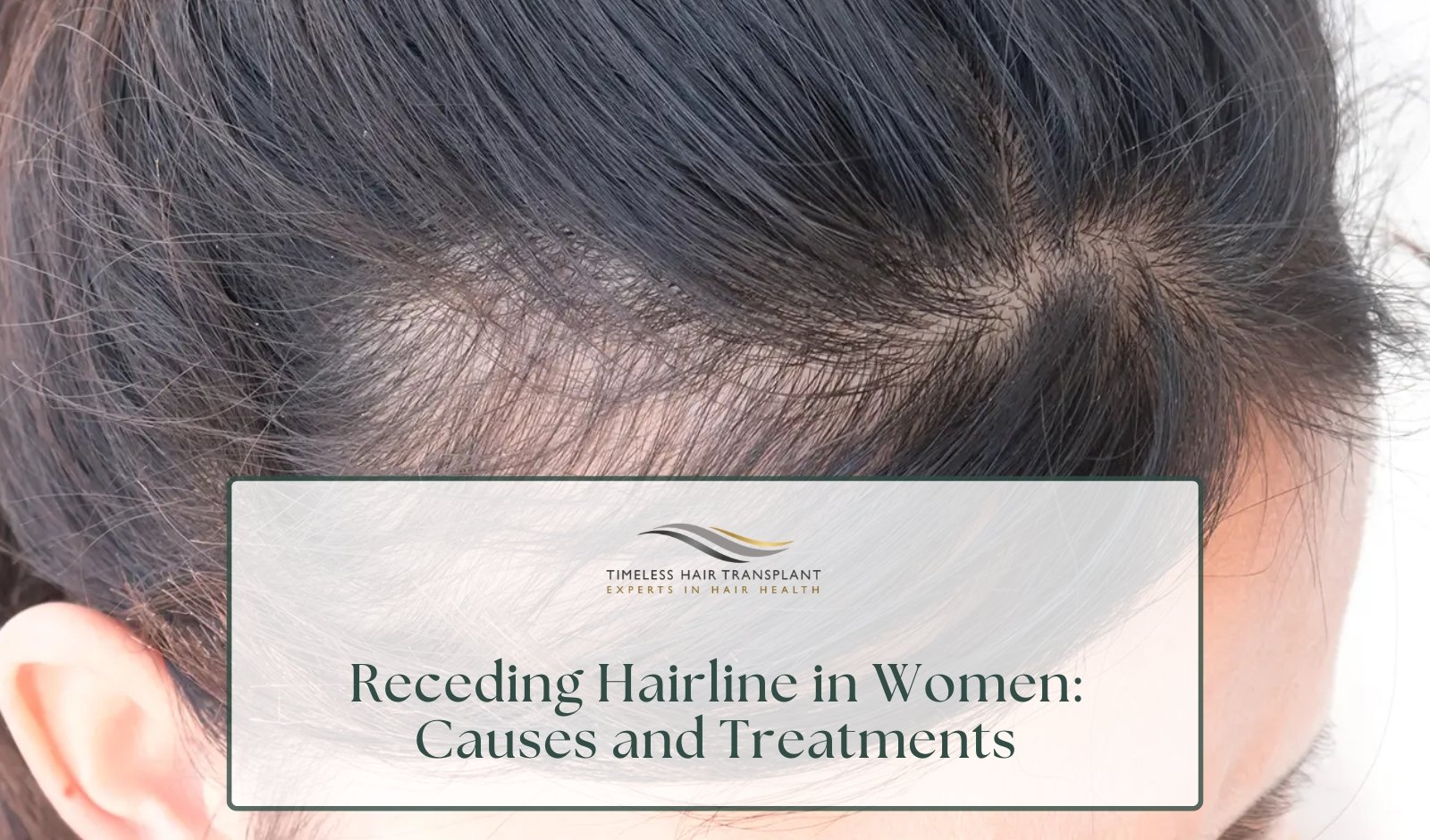 Receding Hairline in Women: Causes and Treatments