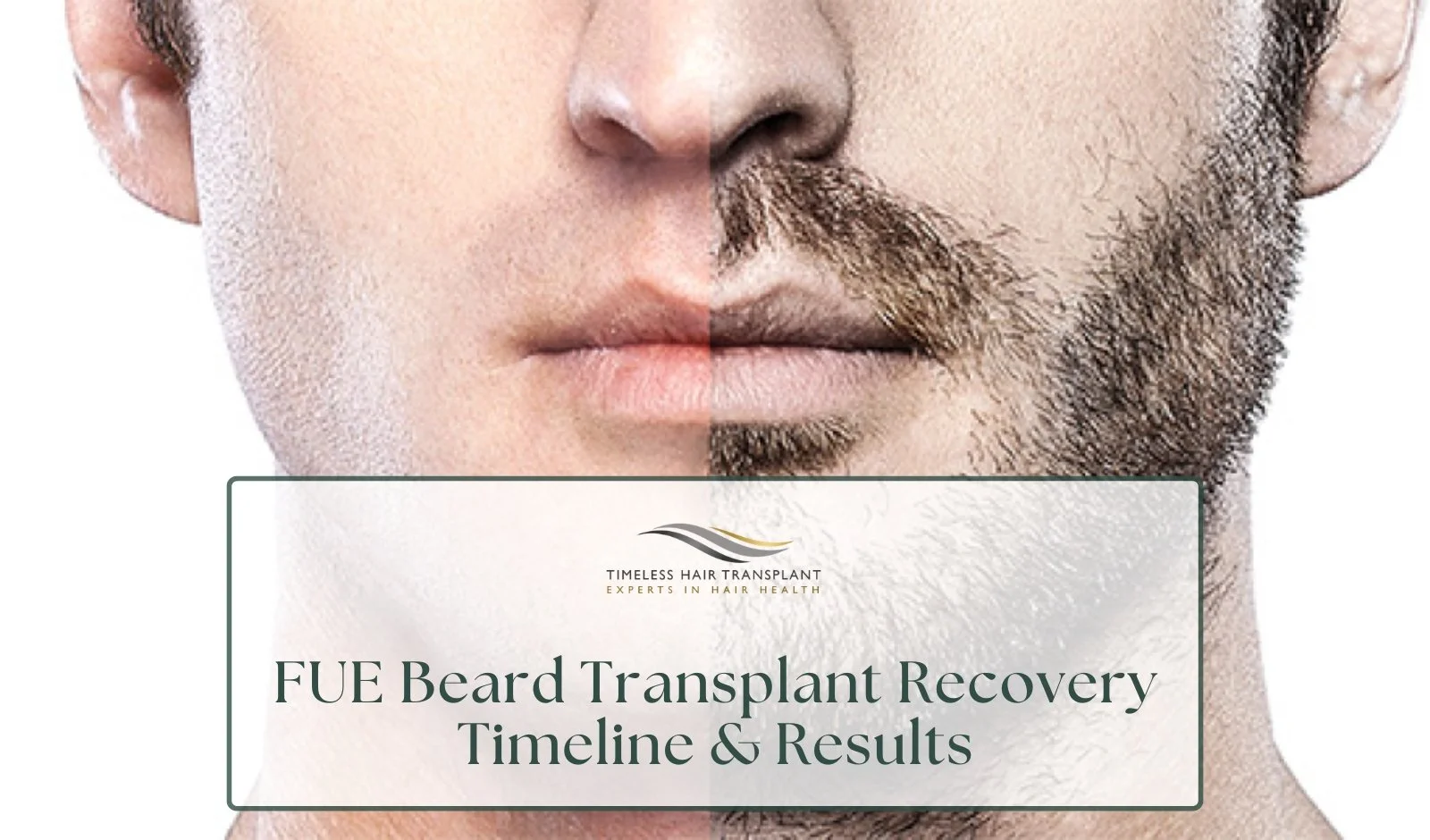 FUE Beard Transplant Recovery Timeline &amp; Results