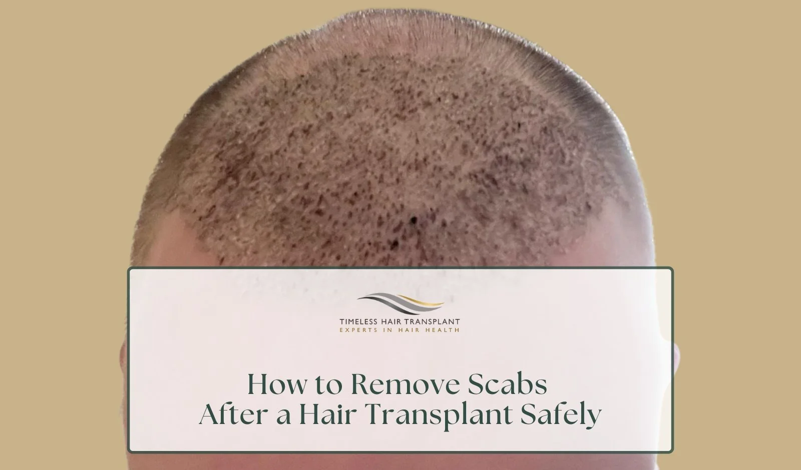 How to Remove Scabs After a Hair Transplant Safely