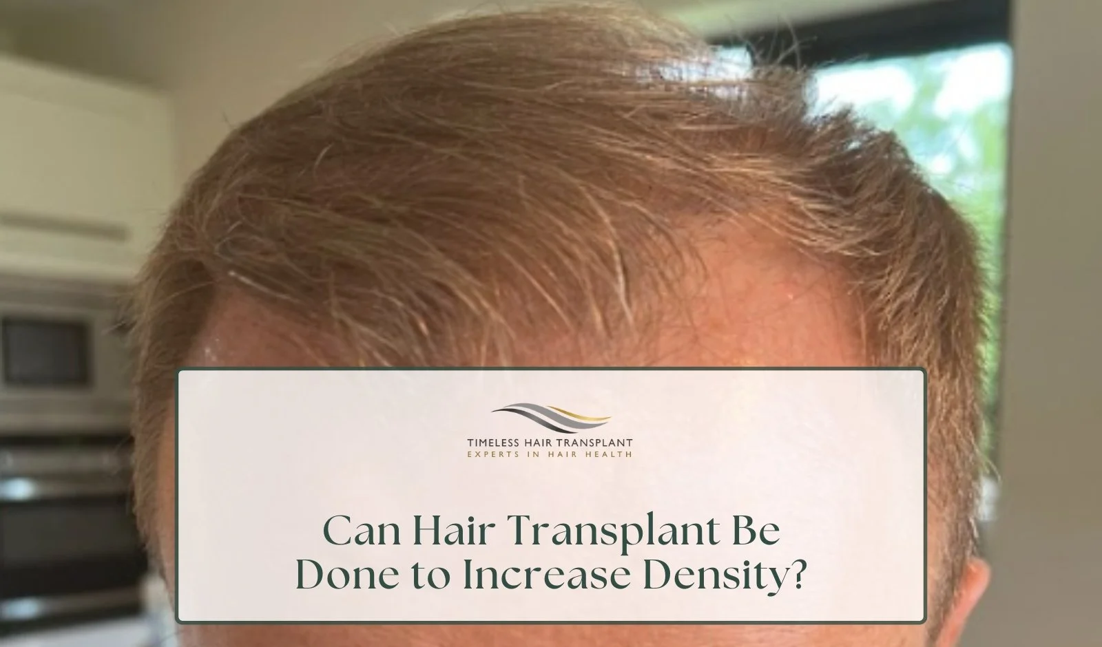 Can Hair Transplant Be Done to Increase Density?