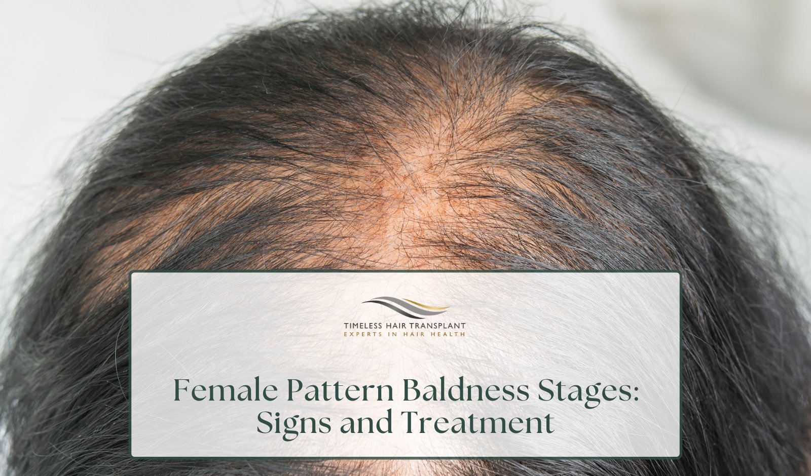Female Pattern Baldness Stages: Signs and Treatment
