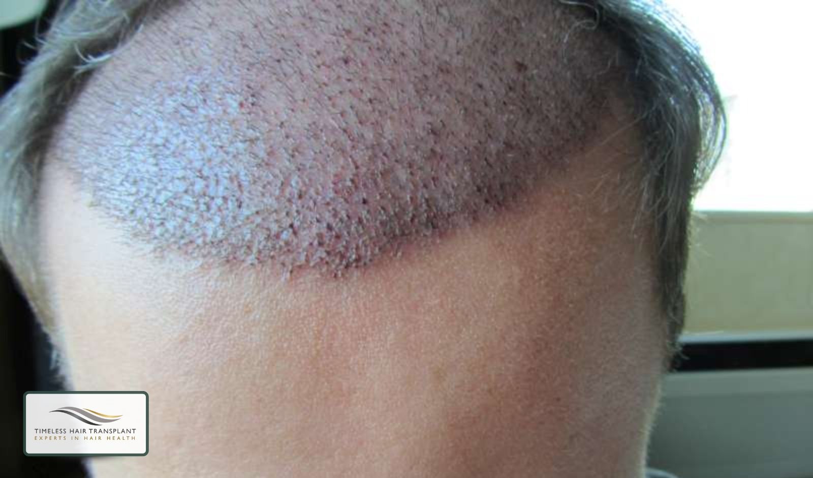 Recovery Time and Side Effect Timeline