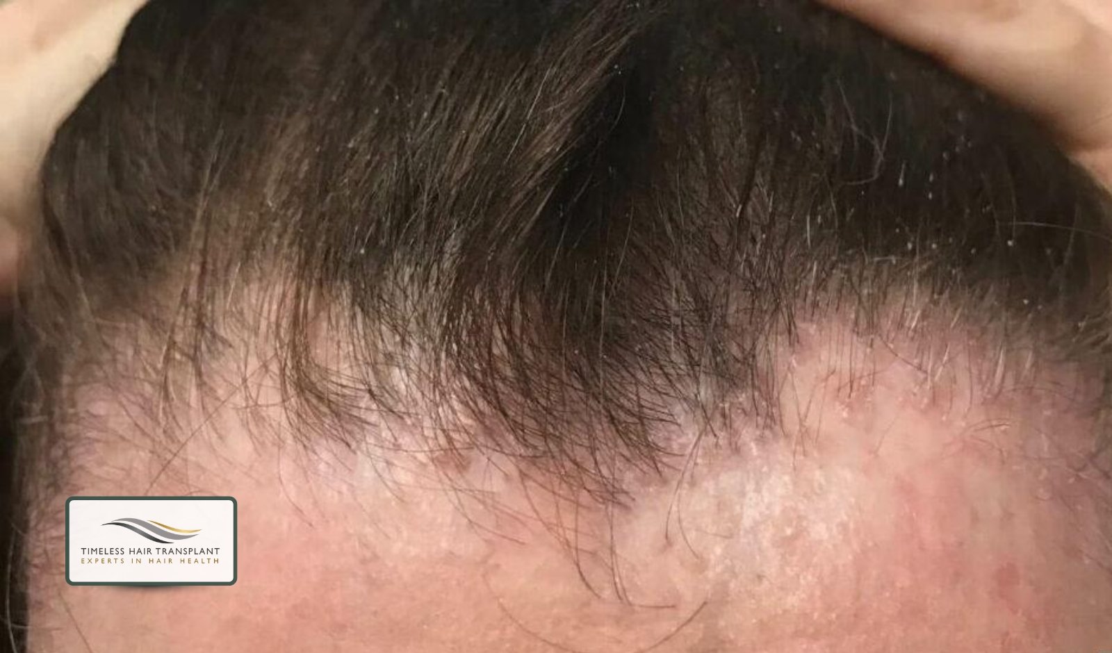 Is Traction Alopecia Permanent