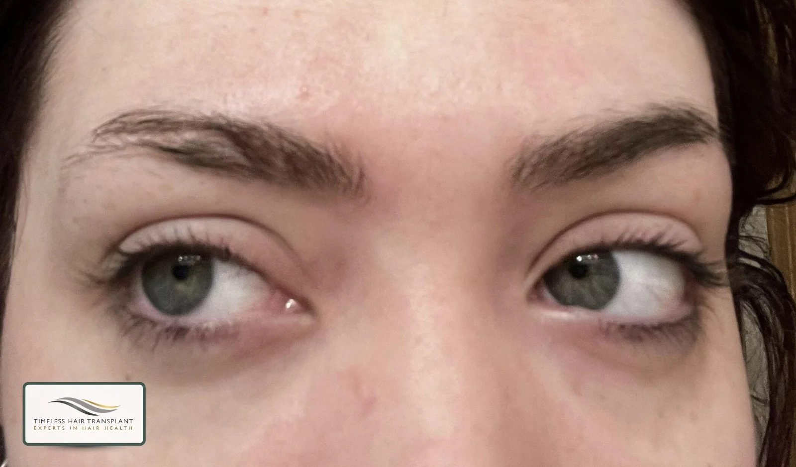 Can Hair Grow in Scar Tissue.jpg