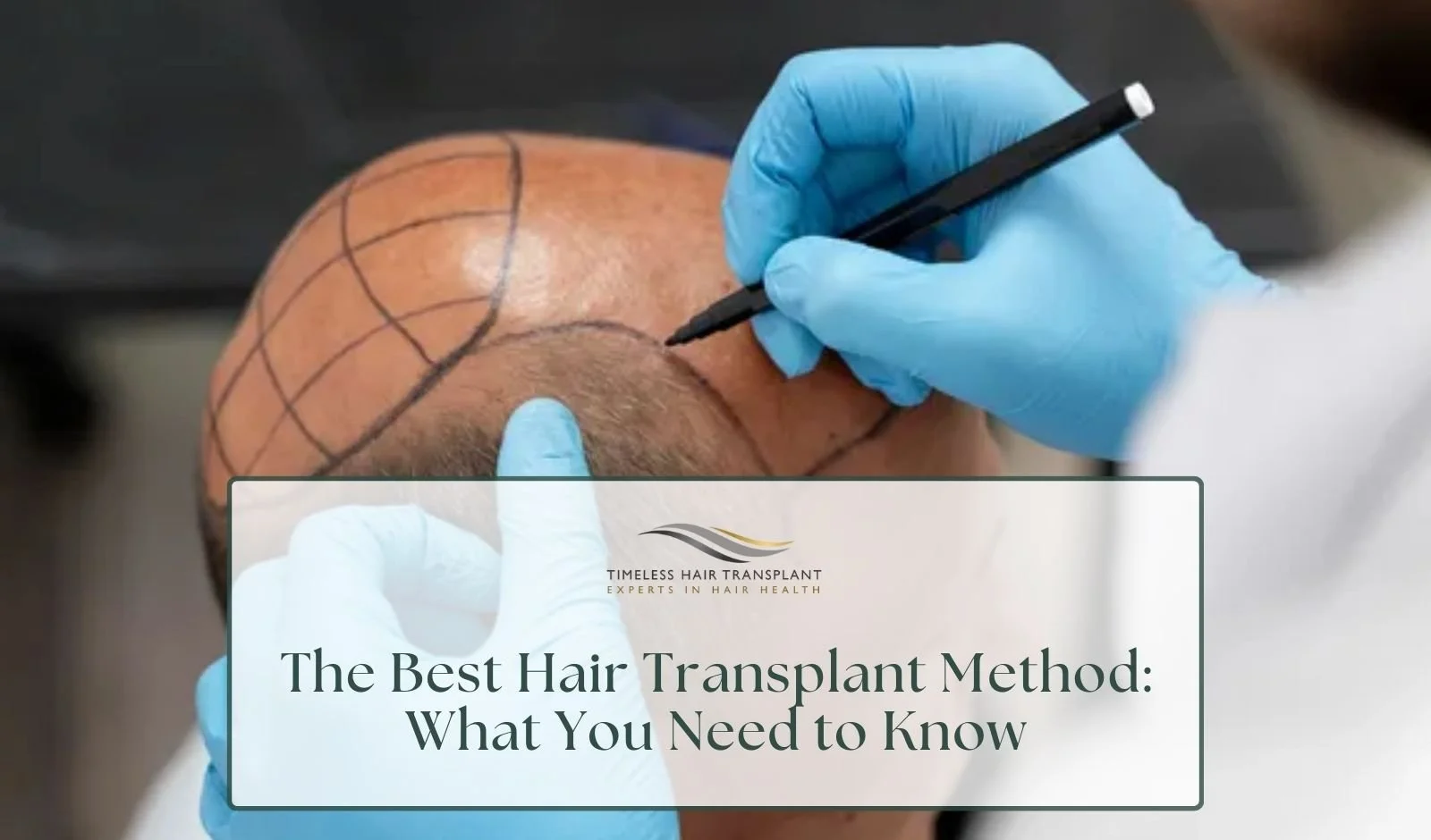 The Best Hair Transplant Method What You Need to Know.jpg