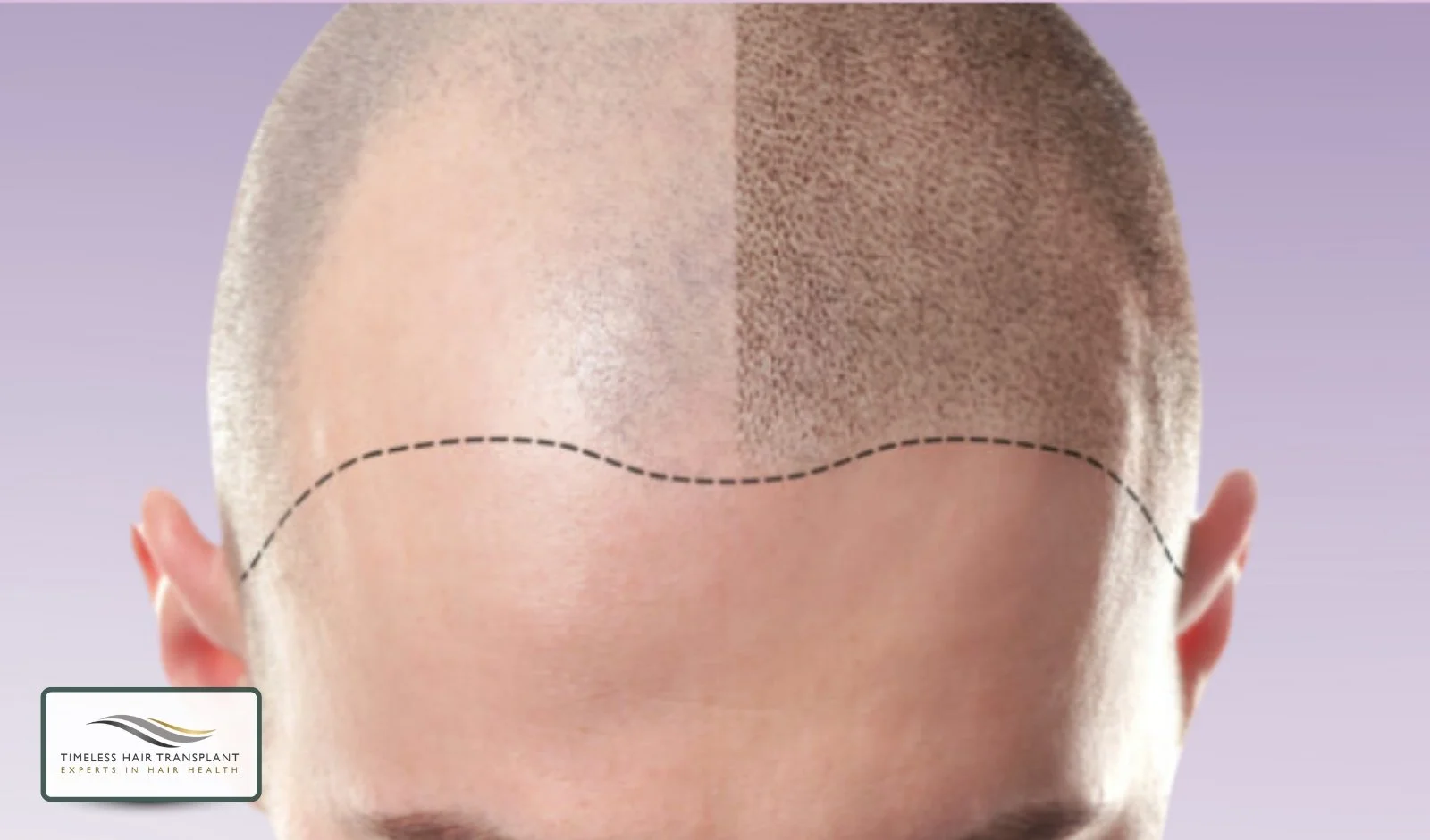 Scalp Micropigmentation