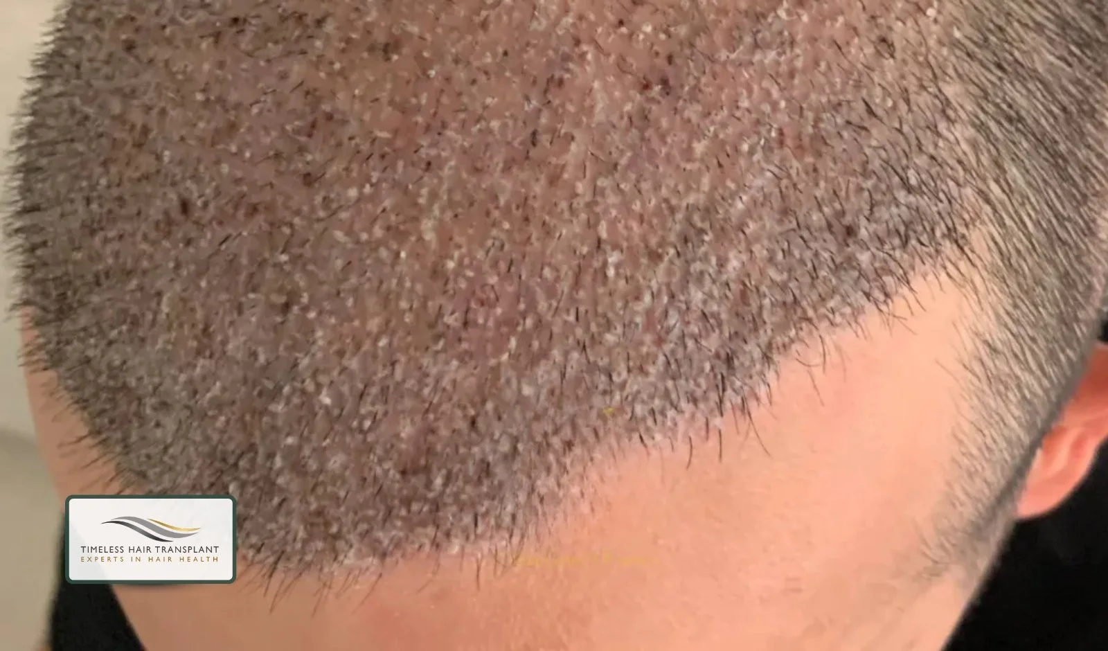 What Happens Right After Surgery