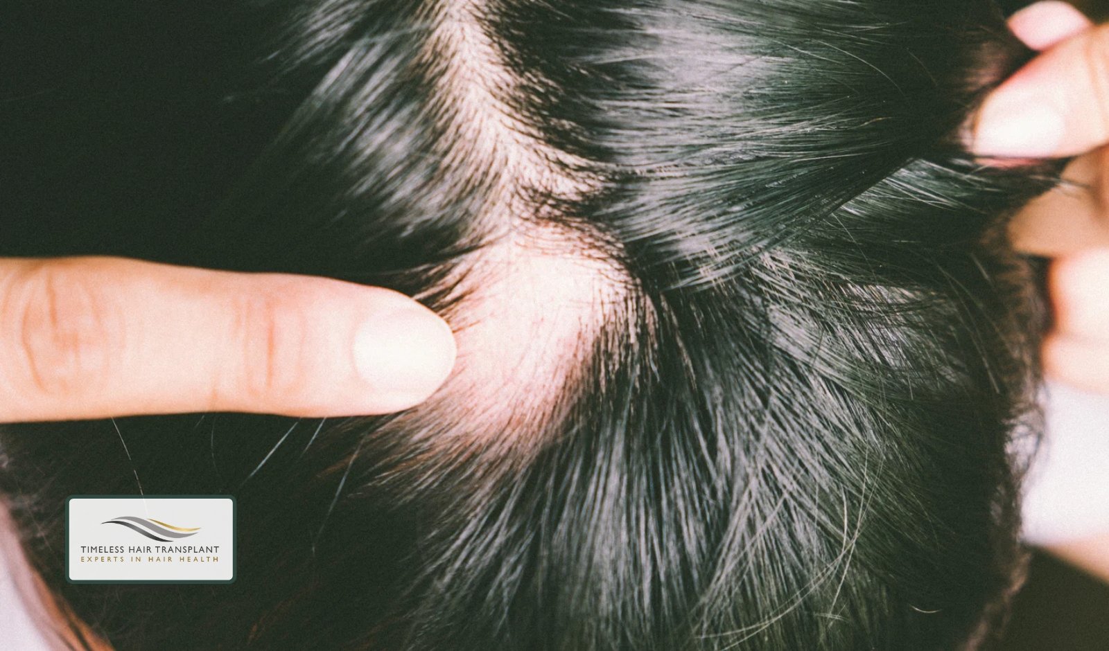 What Is Traction Alopecia