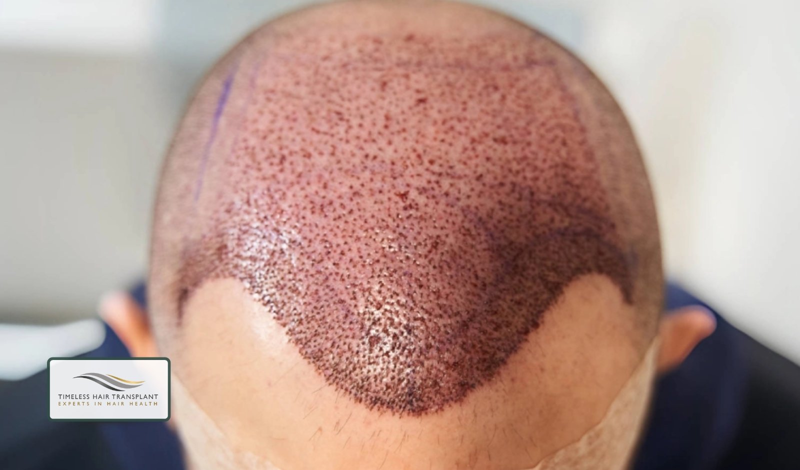 What Happens After a Hair Transplant