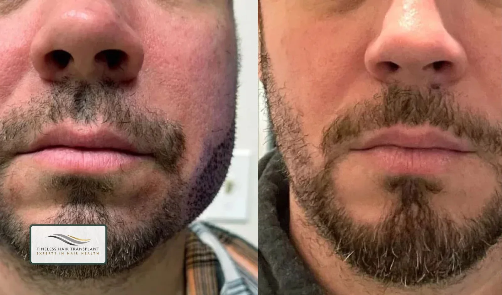 Beard Transplant Recovery Day by Day