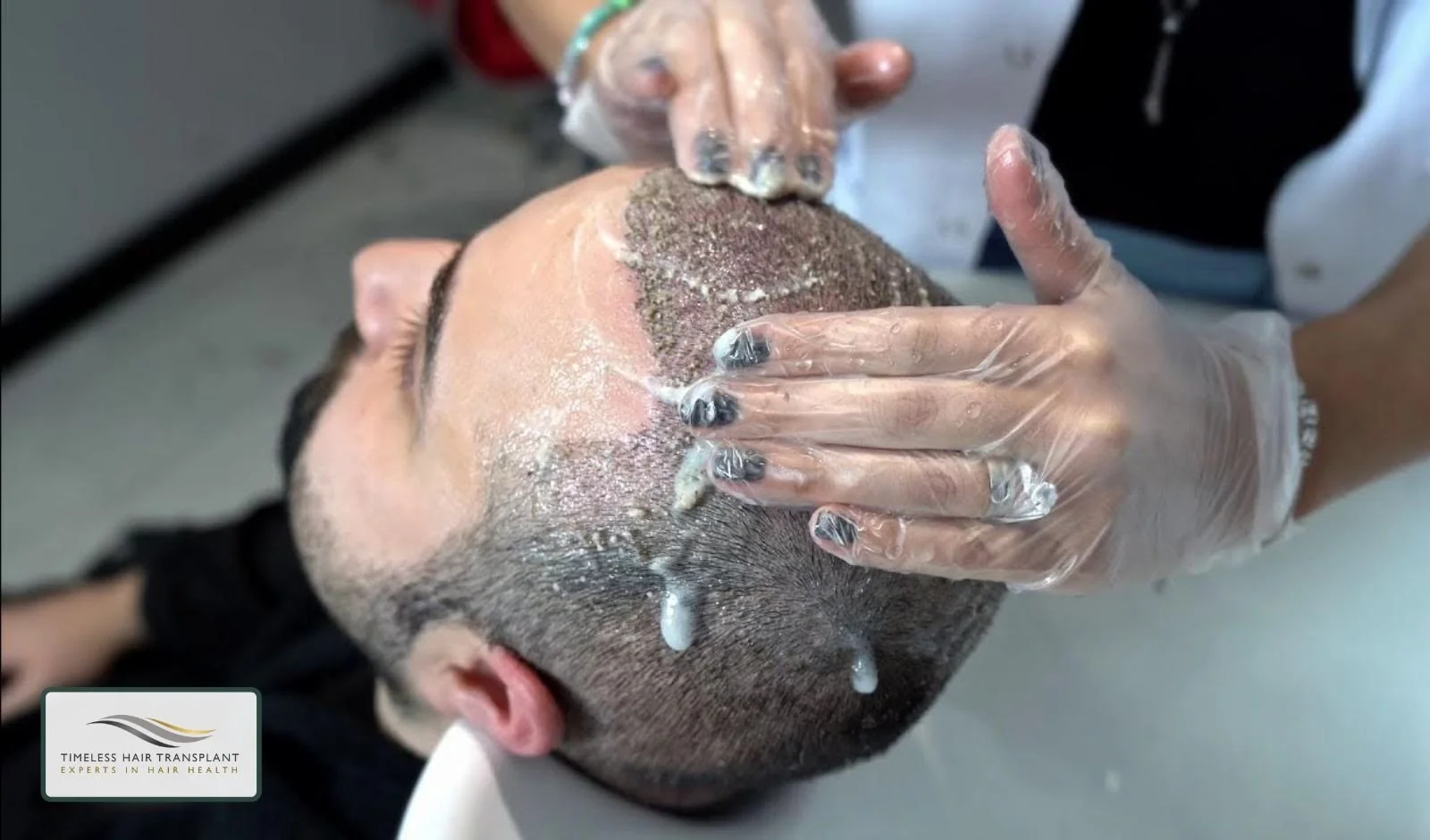 Hair Care After the Initial Healing Process