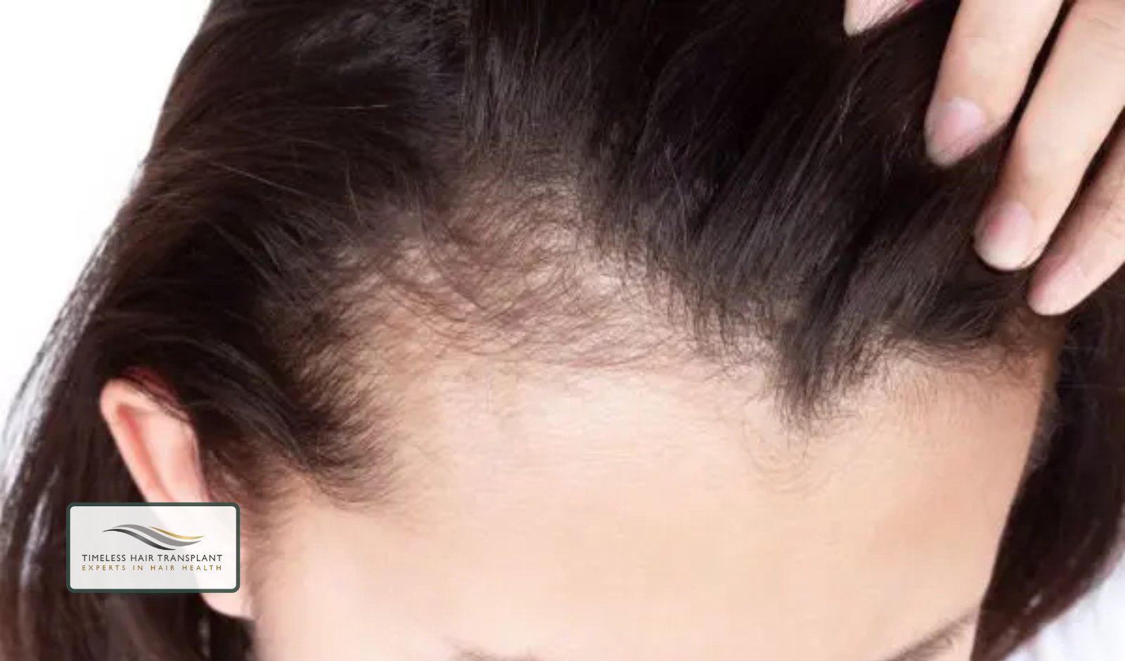 Signs of a Receding Hairline