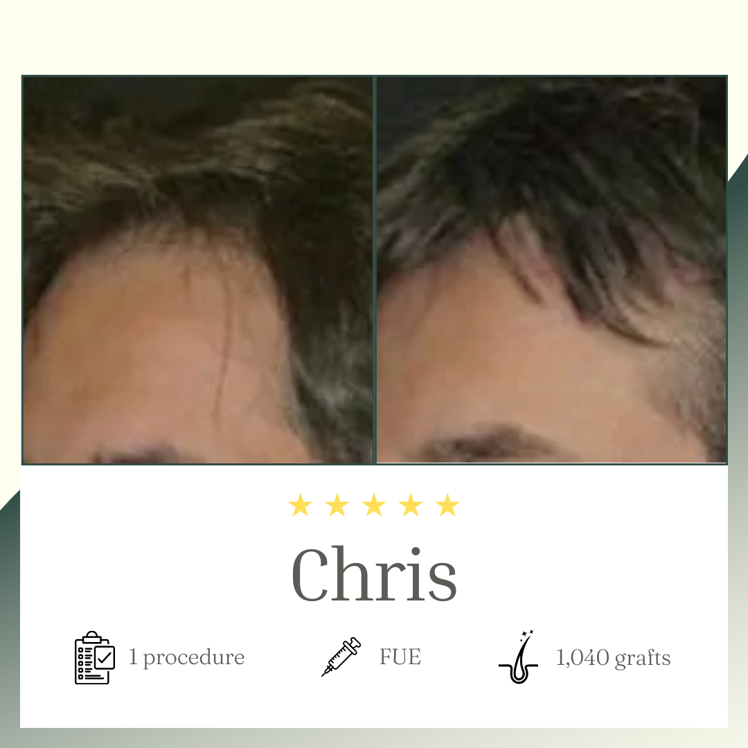FUE procedure - Chris