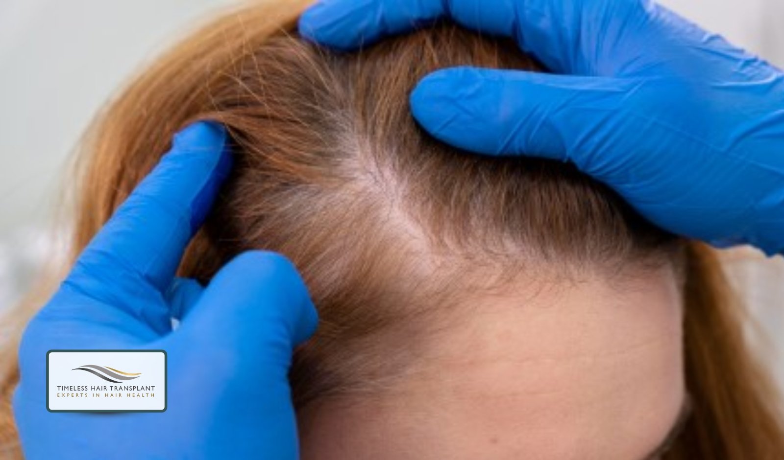 Can Women Have a Hair Transplant Without Shaving