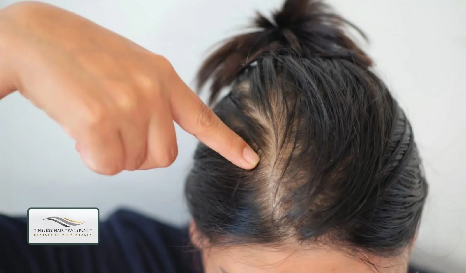 Can Crown Hair Grow Back