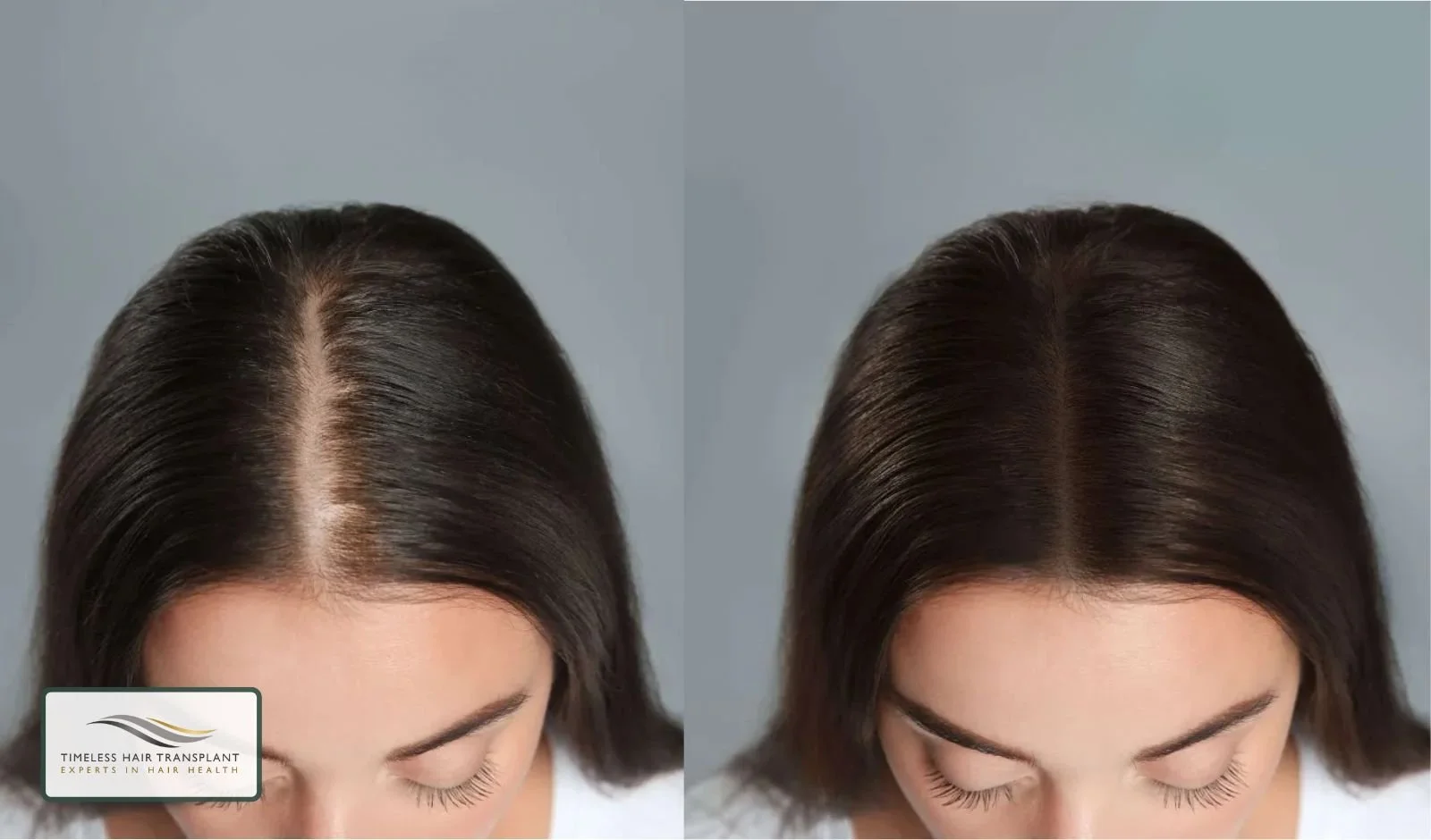 Can Mesotherapy Regrow Hair