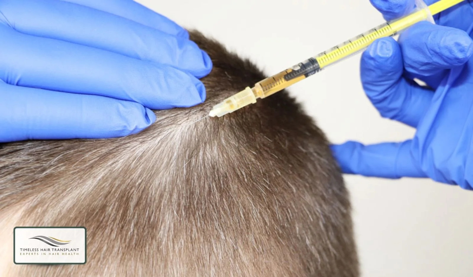 Mesotherapy for Hair Loss