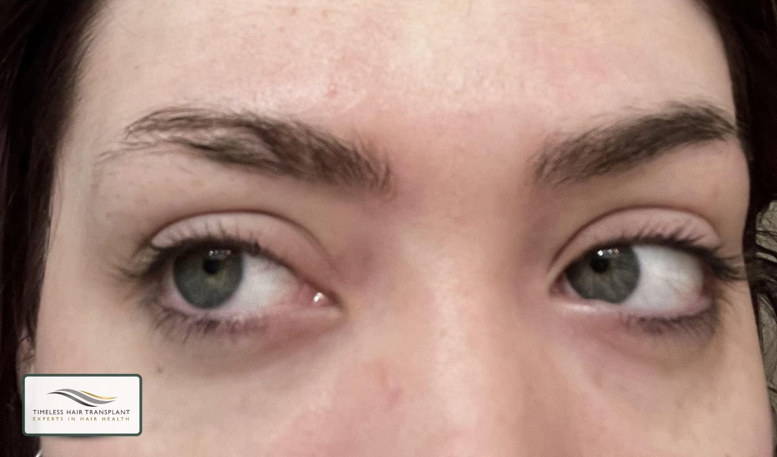 Who Is a Good Candidate for an Eyebrow Transplant