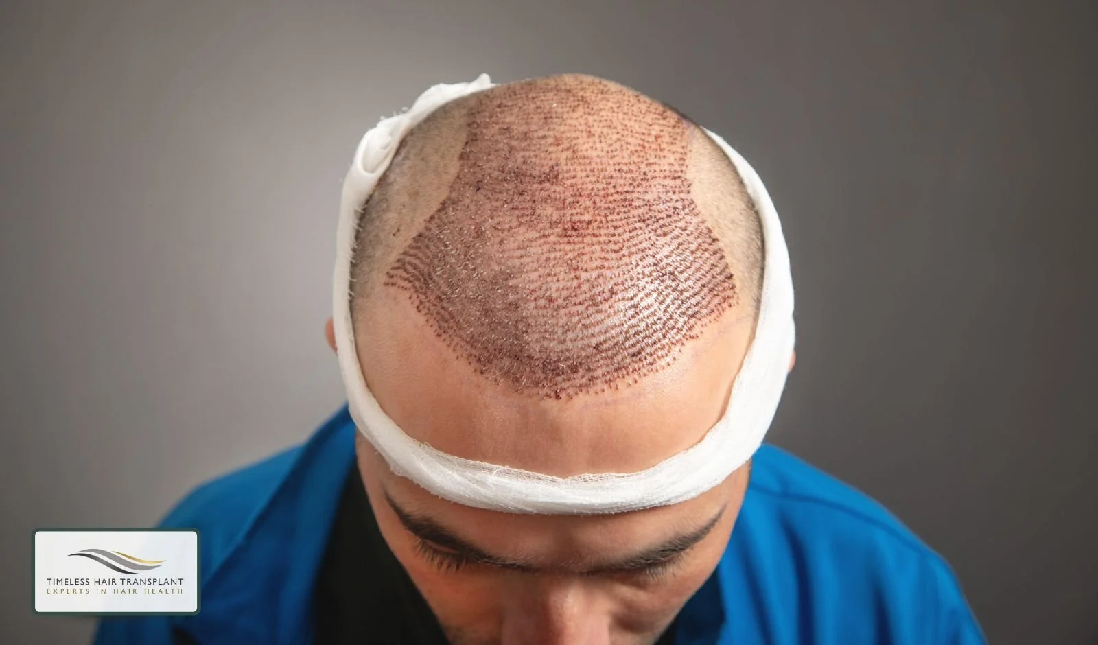 FUE Hair Transplant