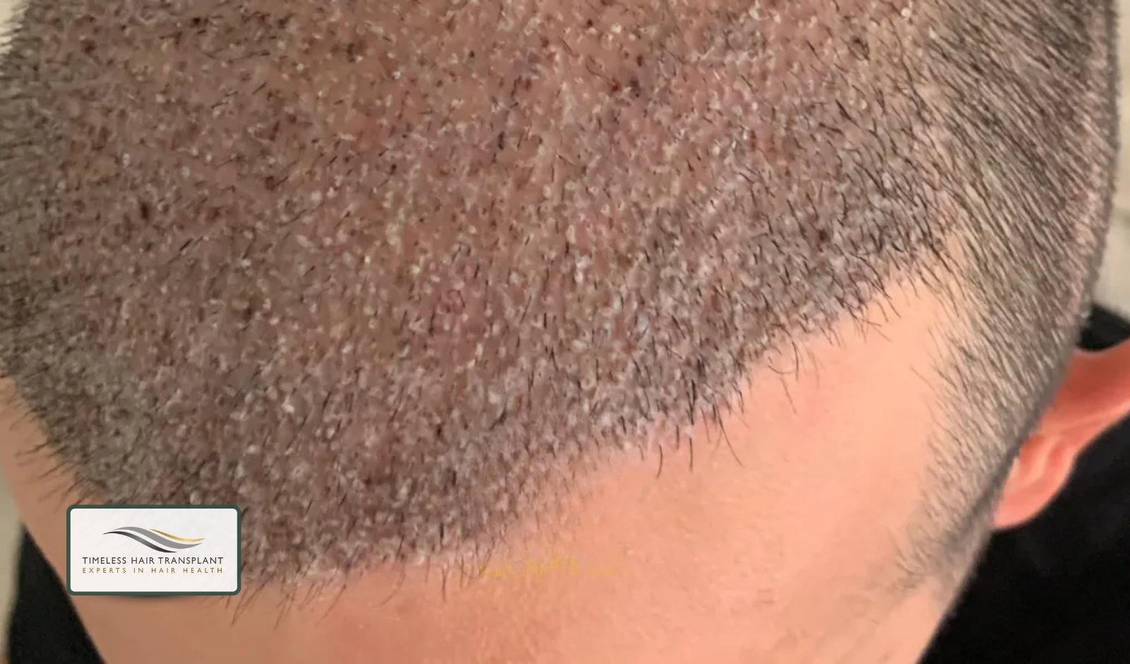 Why You Should Avoid Scratching