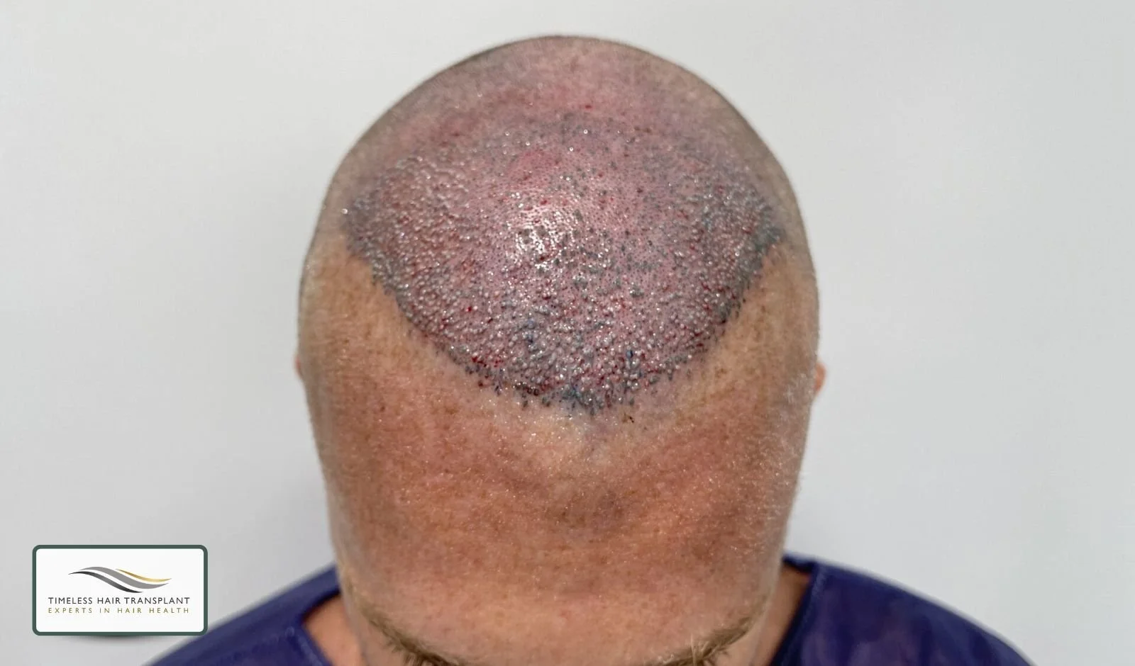 Common Side Effects of FUT Hair Transplant