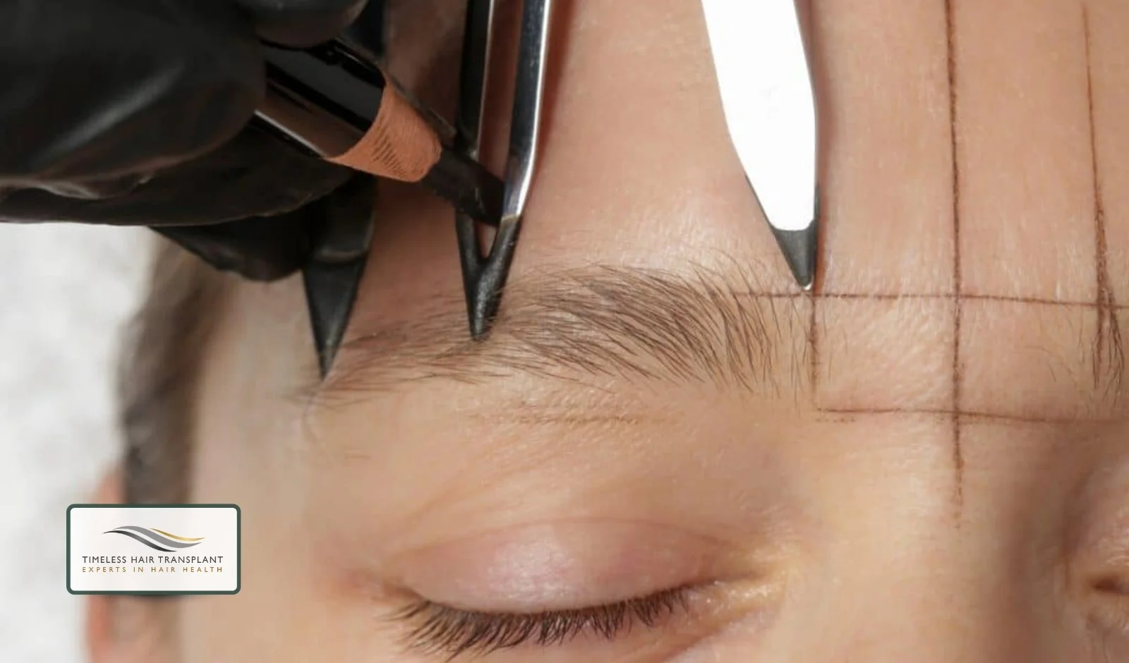 The Donor Area Where the Hair Comes From