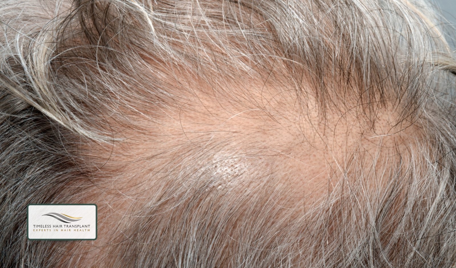 Telogen Effluvium and Stress