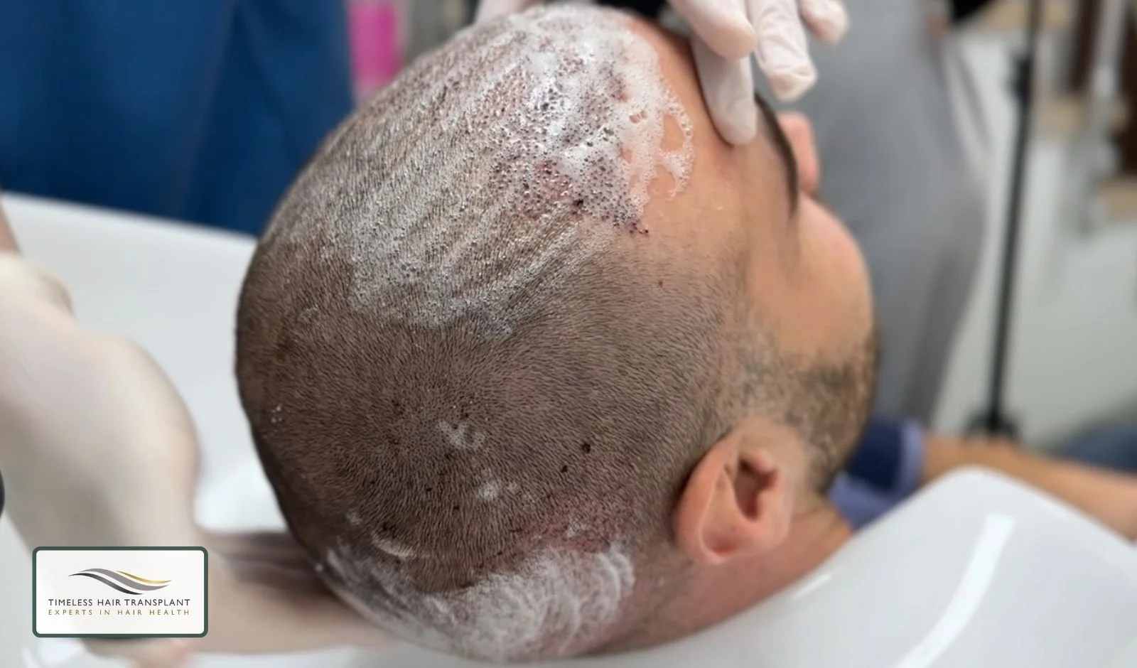 Why Washing Hair After a Hair Transplant Matters