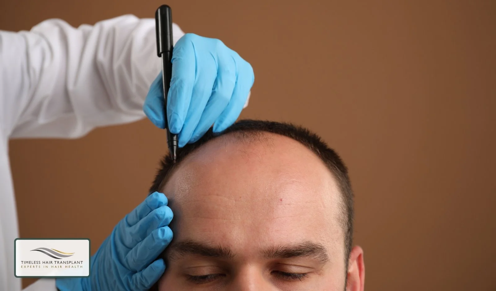 How Permanent Is a Hair Transplant