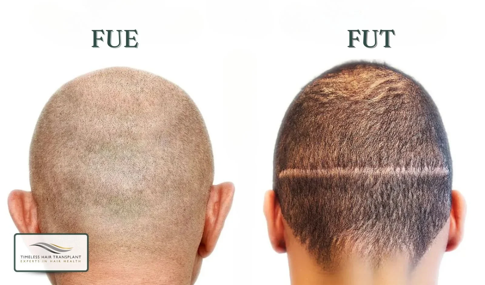 Understanding the Two Main Hair Transplant Methods
