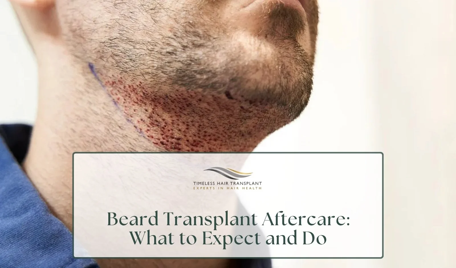 Beard Transplant Aftercare What to Expect and Do