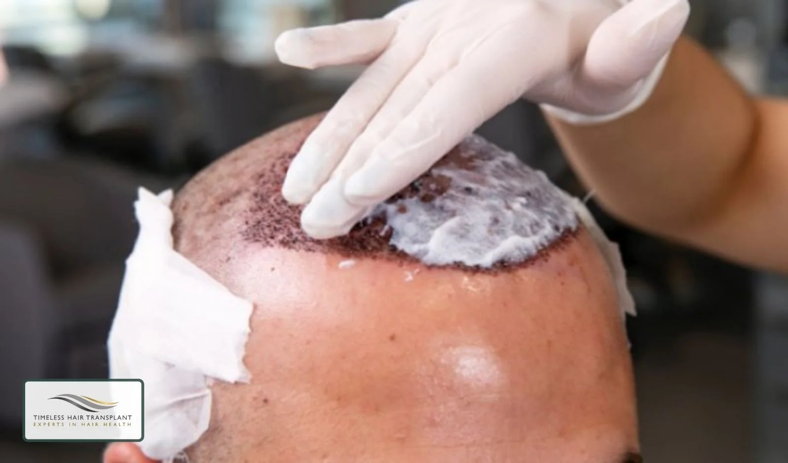 Why Aftercare Matters After a Hair Transplant