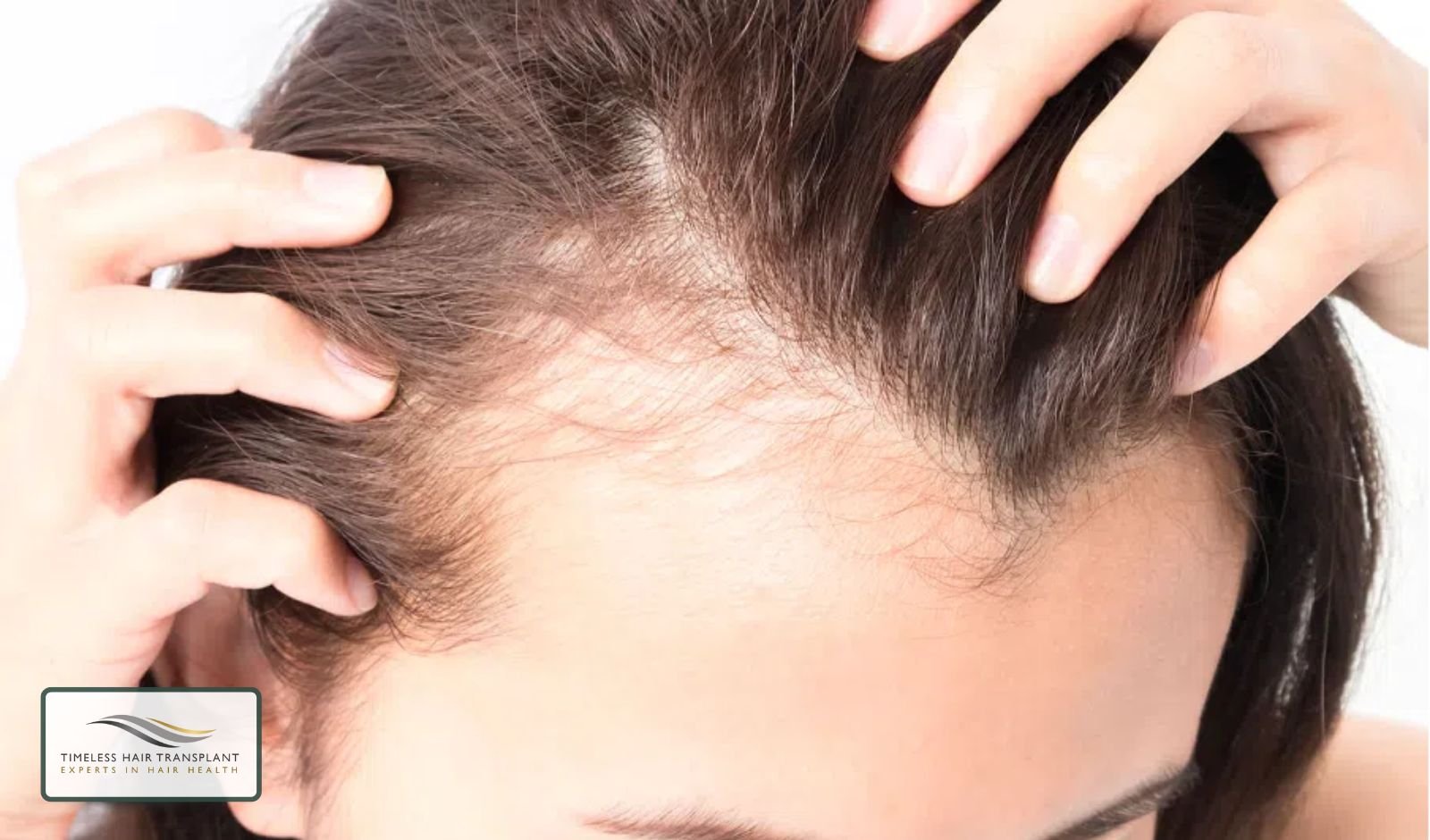Understanding Female Hair Loss Patterns