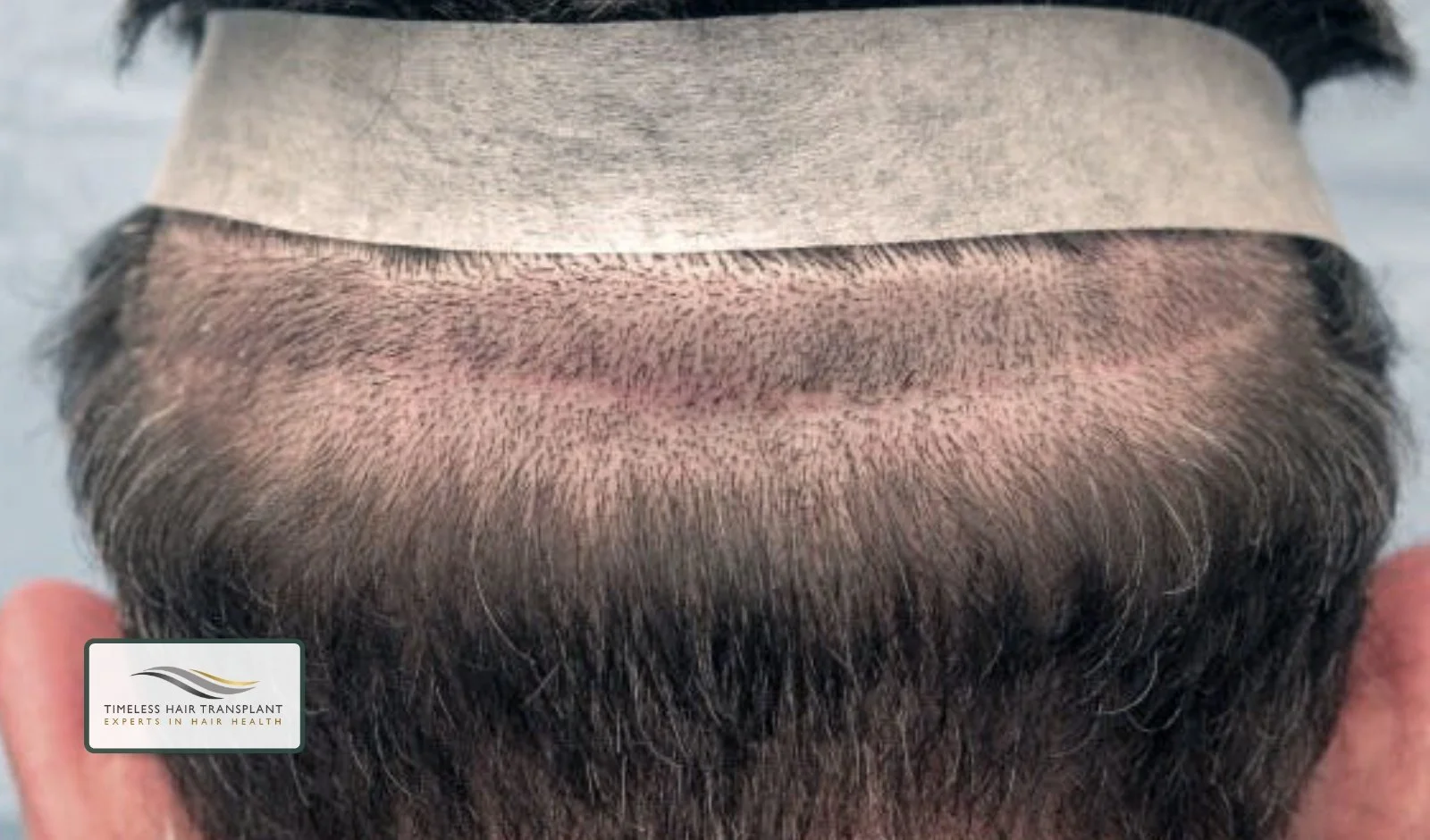 The Donor Area Where the Hair Comes From