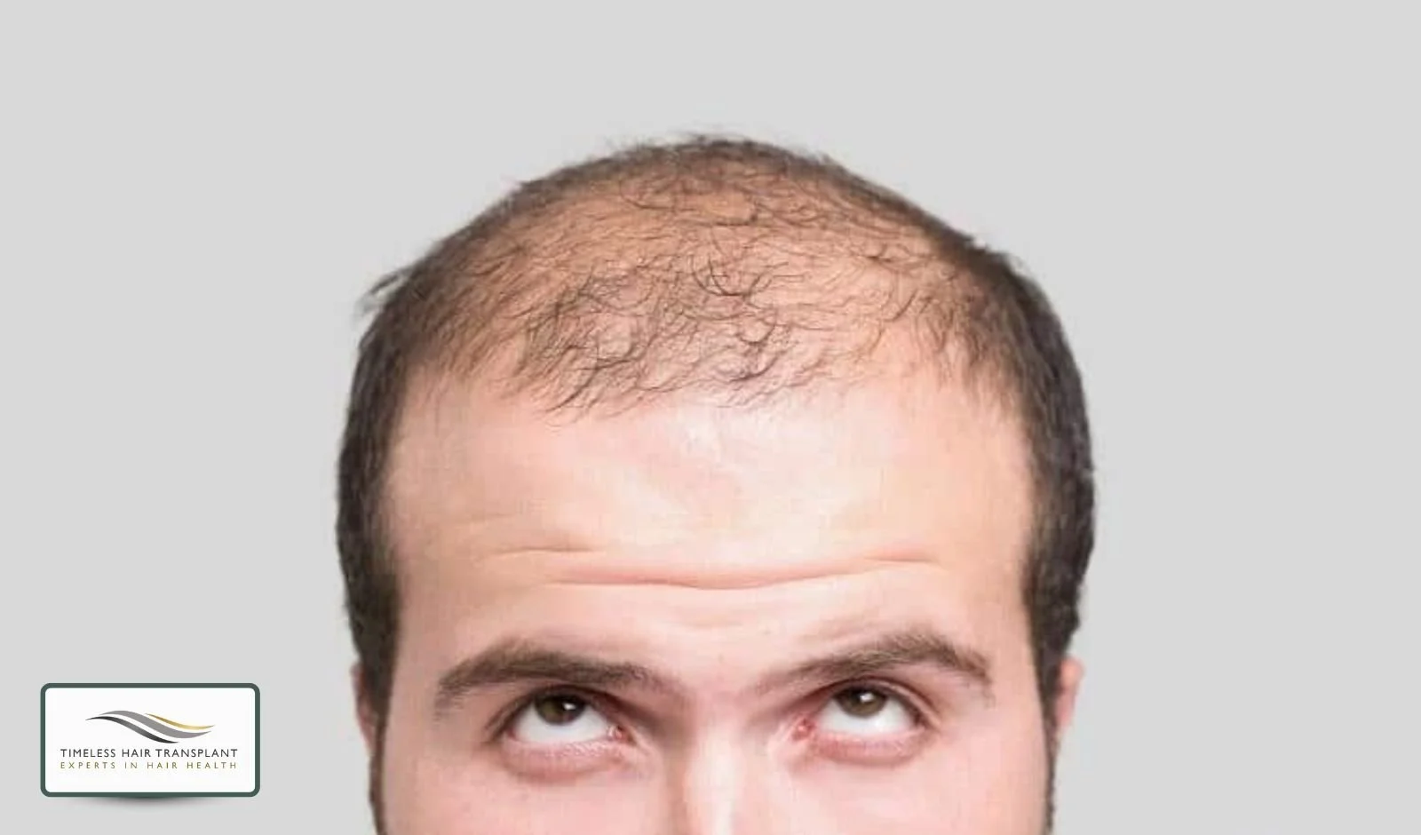 Do Not Panic About Shedding