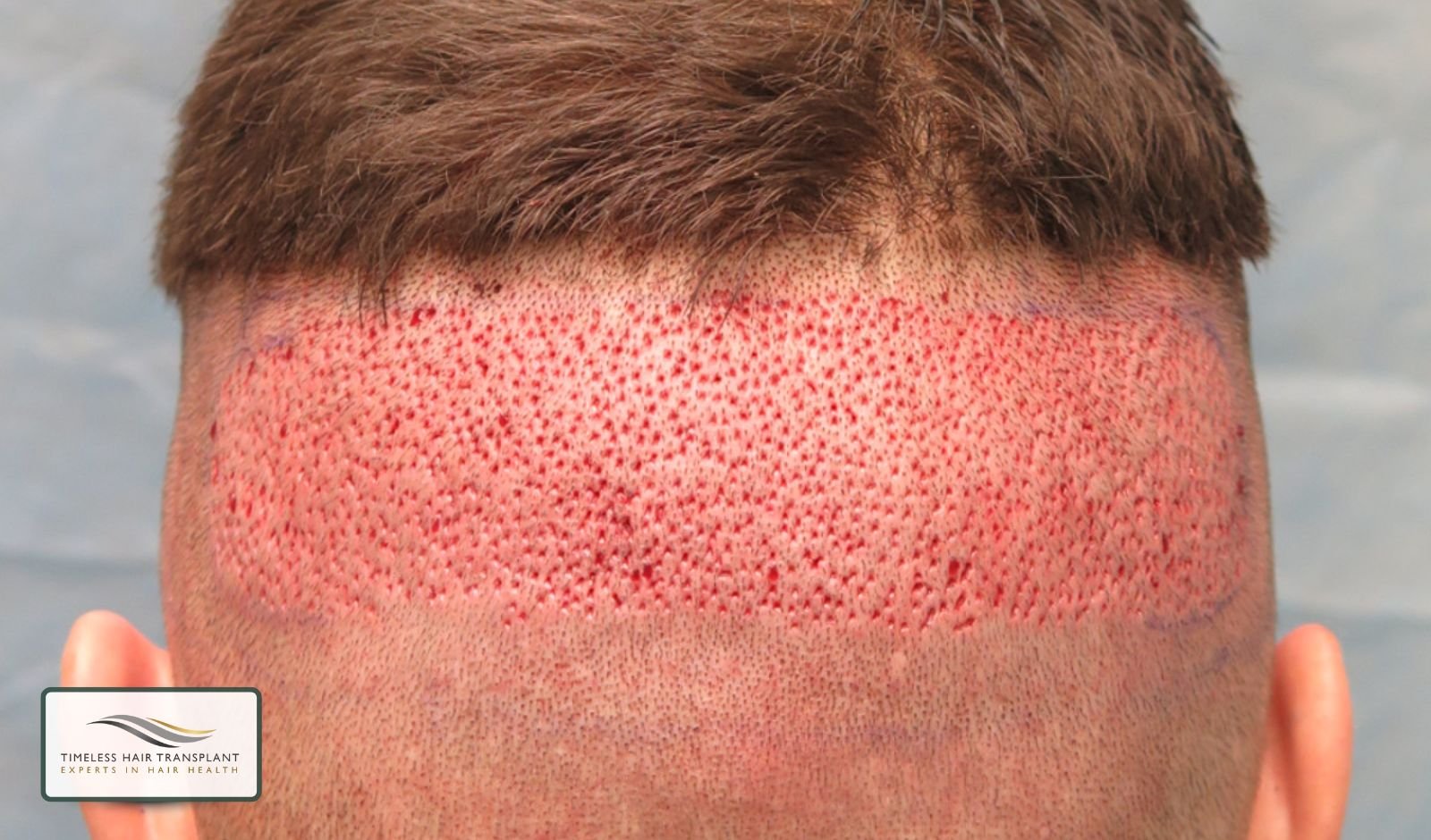 Pain in the Donor Area After Hair Transplant FUE