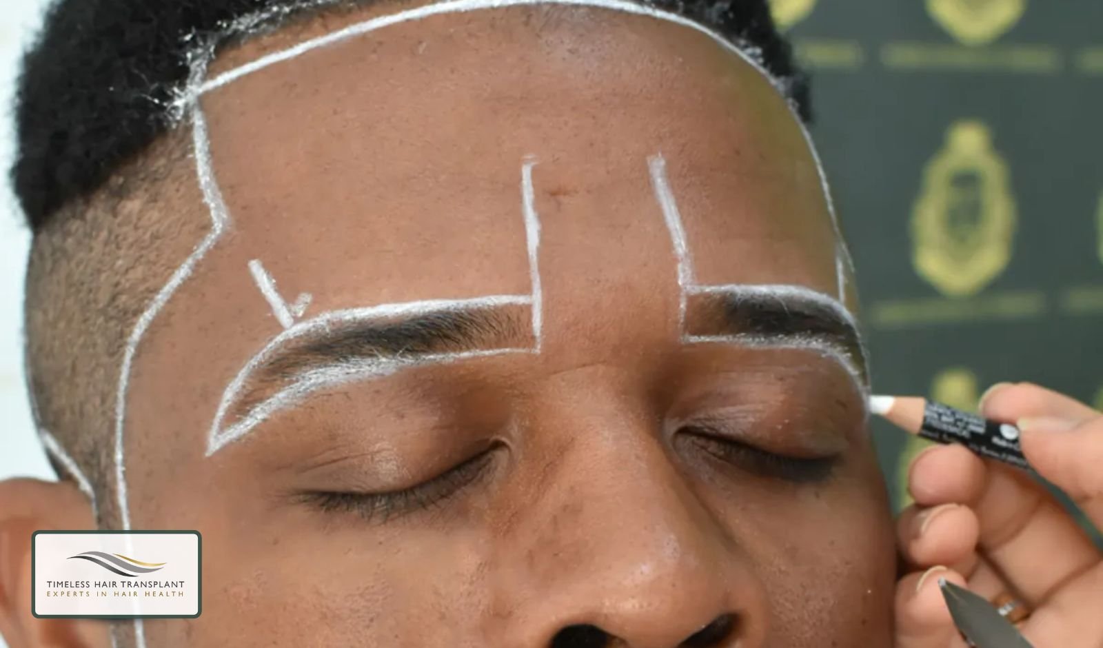 How the Eyebrow Transplant Procedure Works