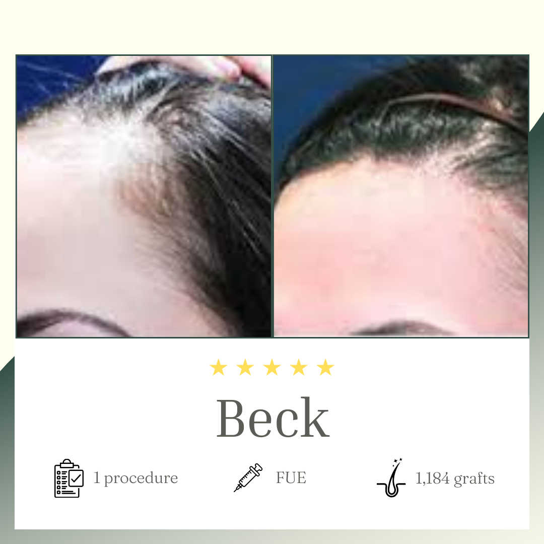 FUE procedure - Beck