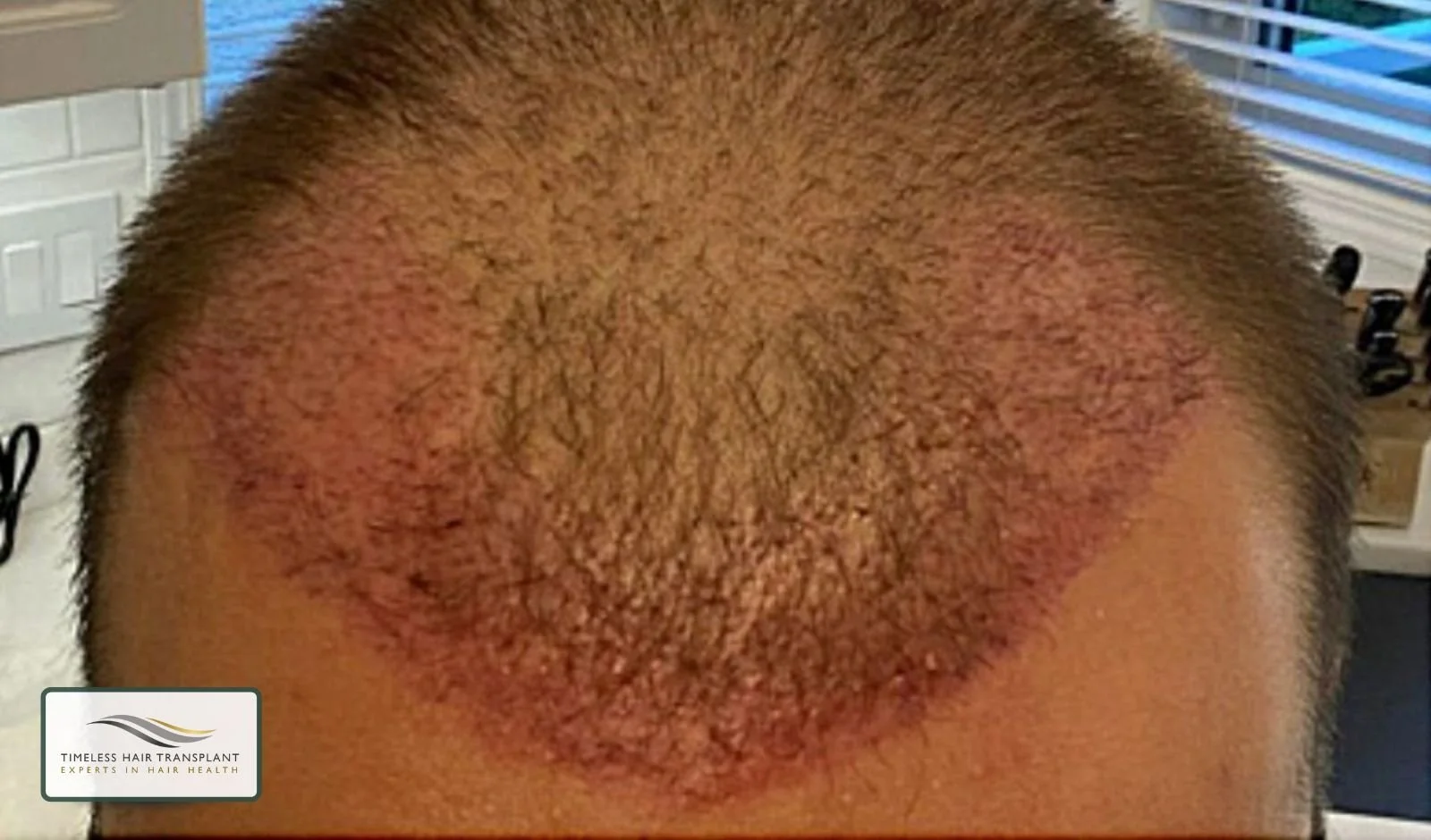 Why FUE Hair Transplants Are Considered Minimally Painful