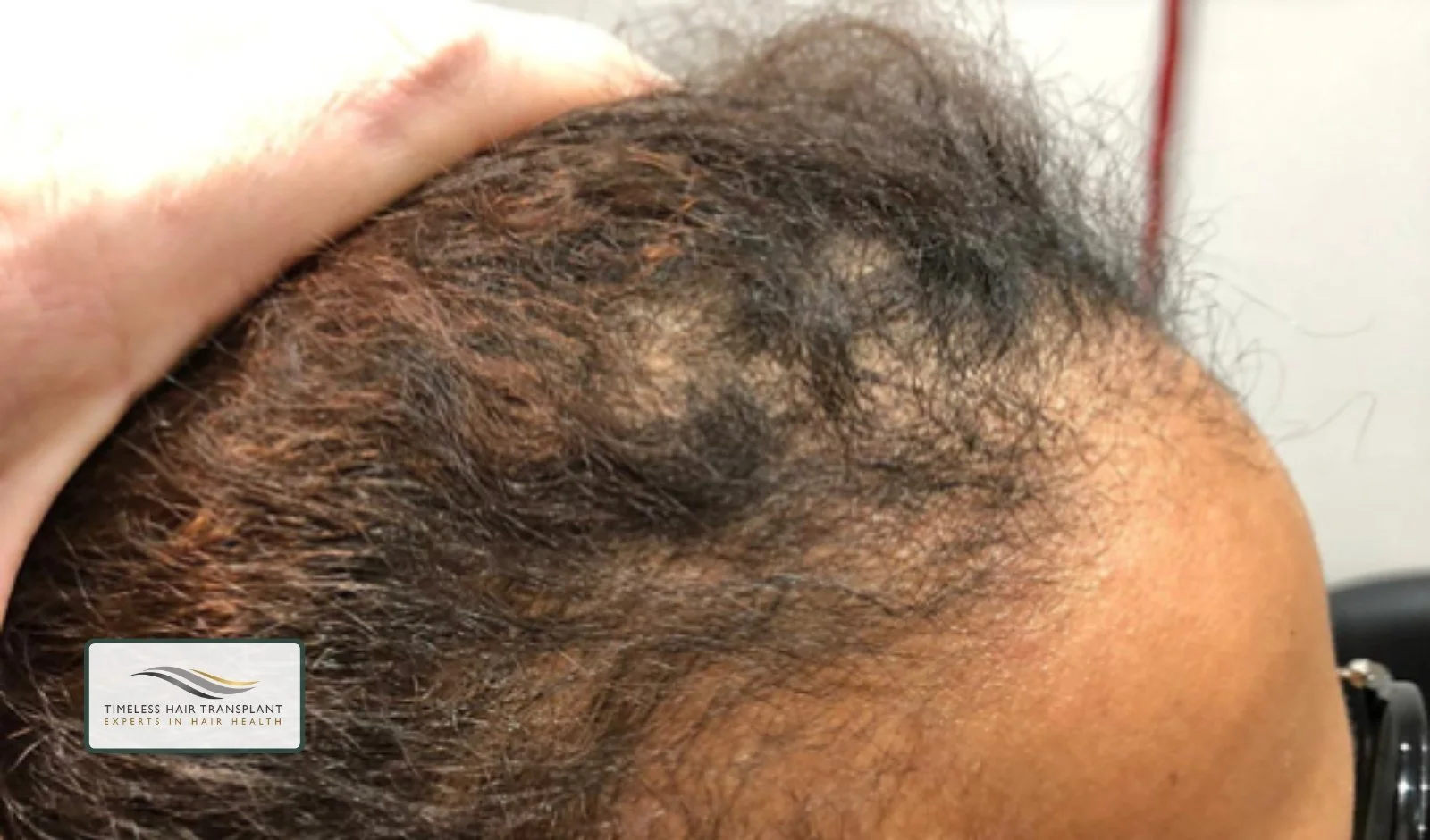 What Is Traction Alopecia