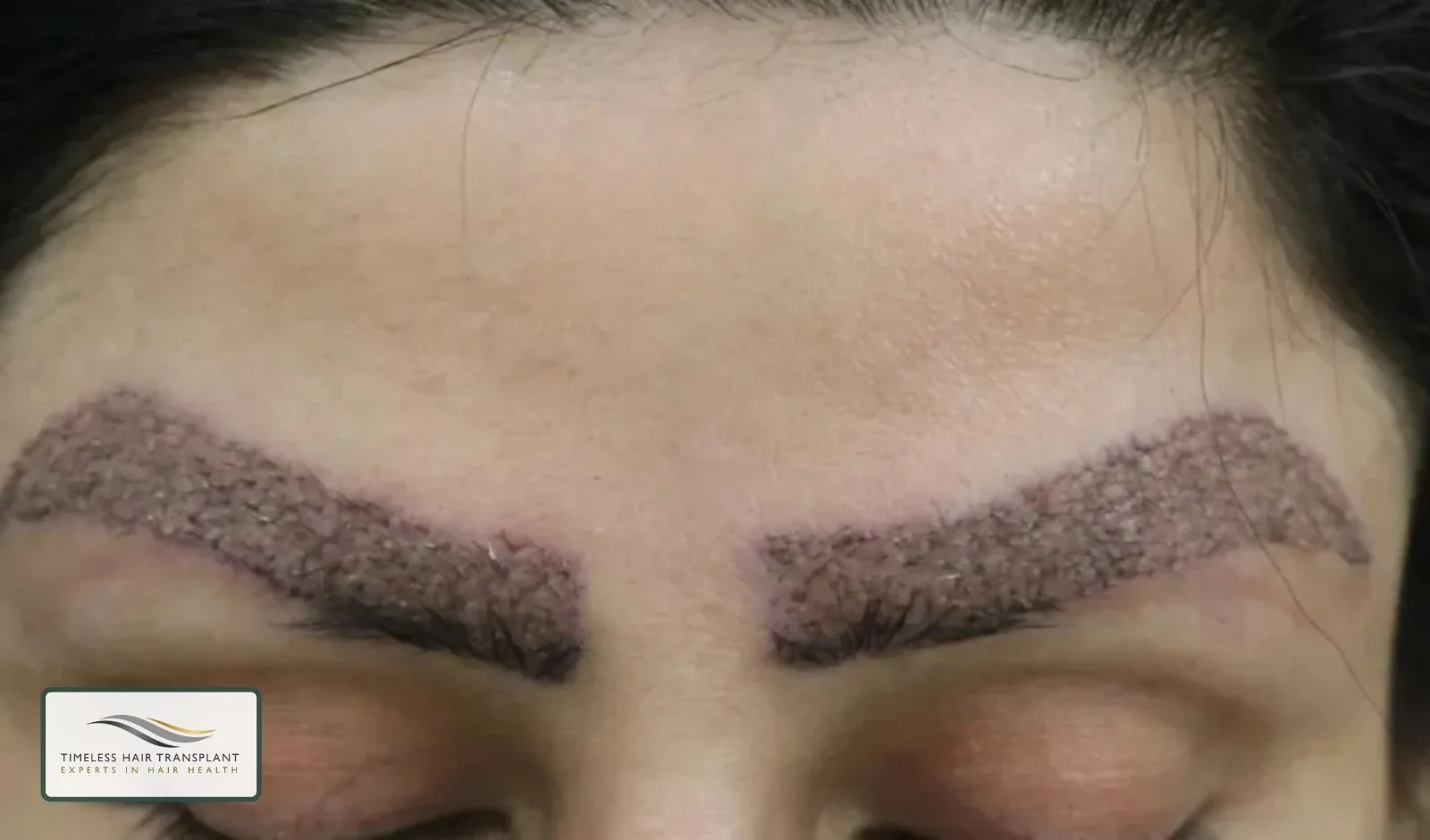 Eyebrow Transplant Recovery Time Week by Week