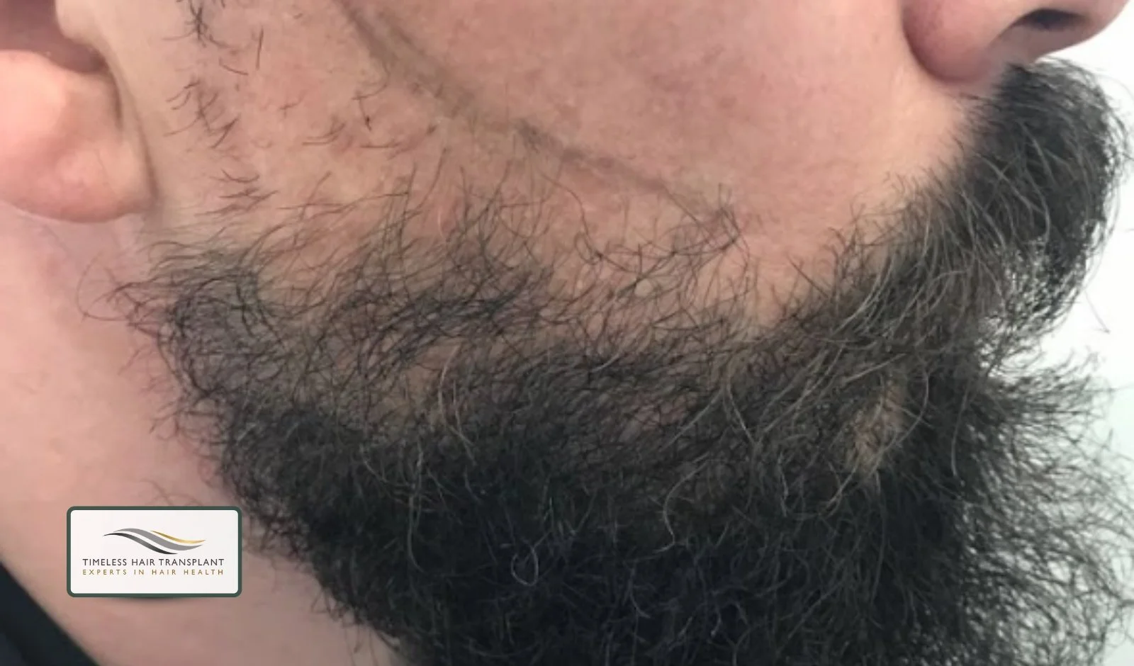 What Is a Beard Transplant