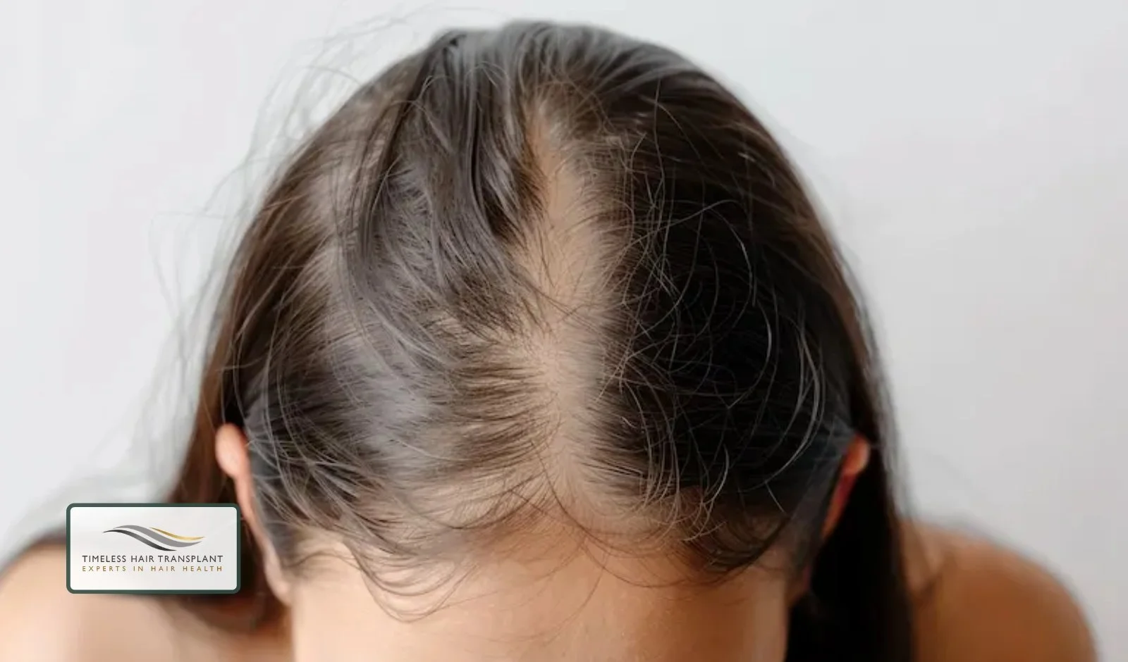What Is Crown Hair Loss in Women
