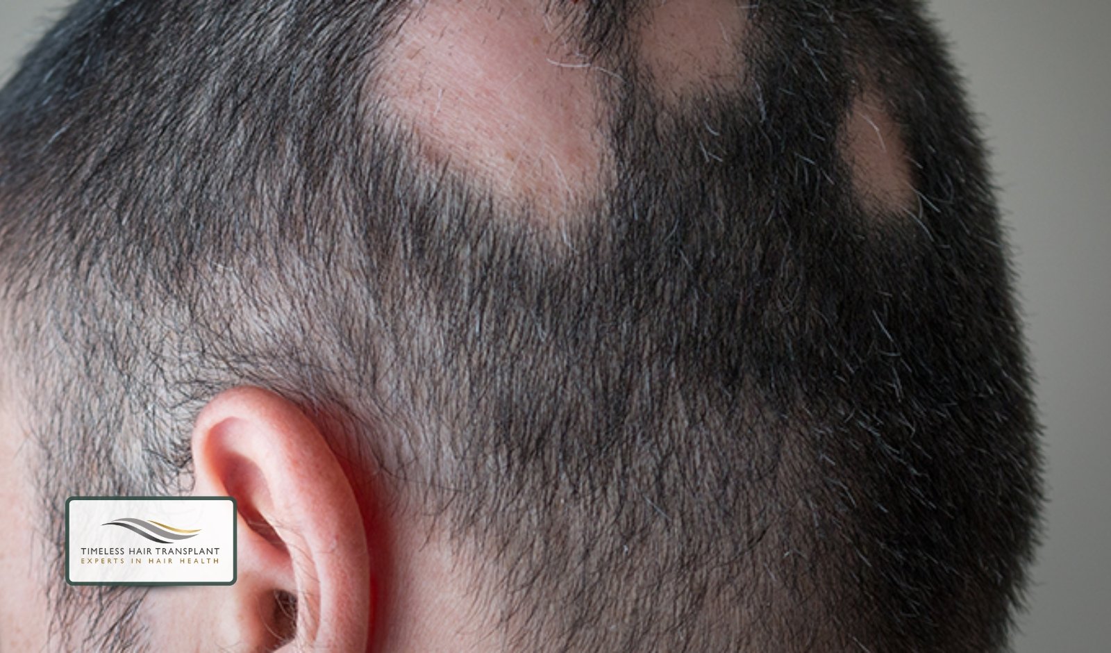 Main Causes of Traction Alopecia