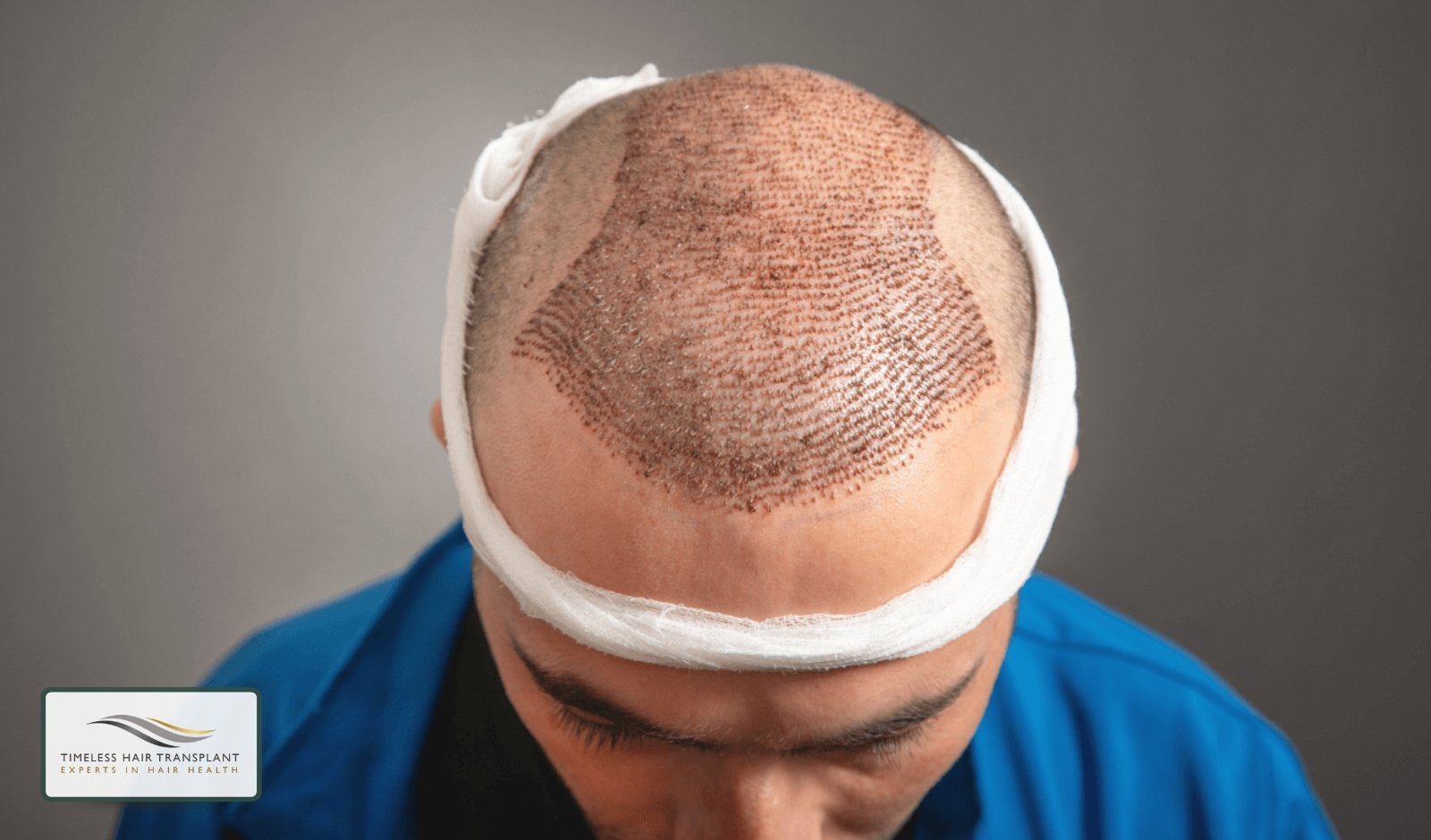 How Hair Transplantation Works