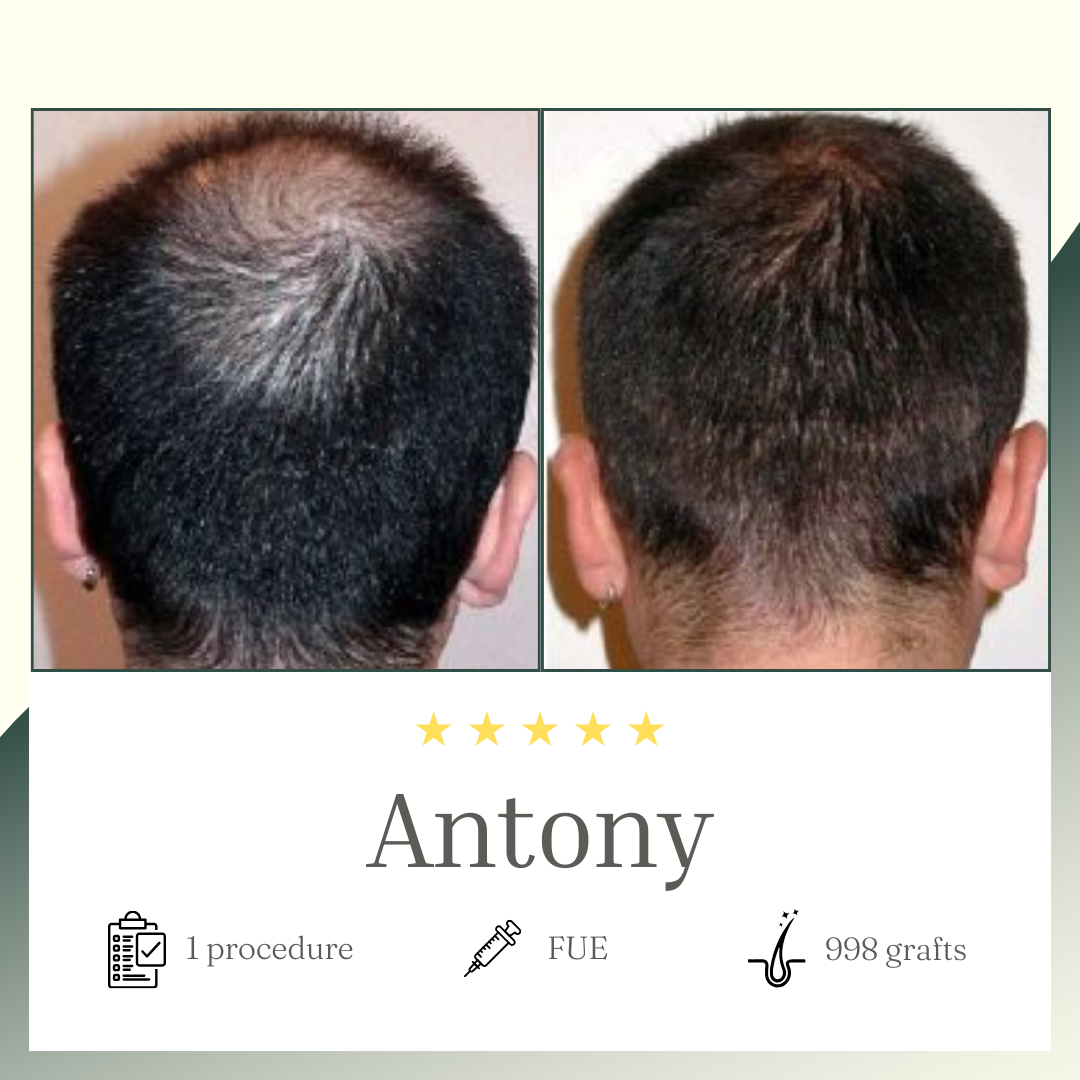 FUE procedure - Antony