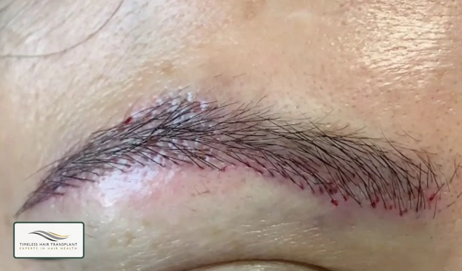 Does Eyebrow Transplant Hair Grow Long